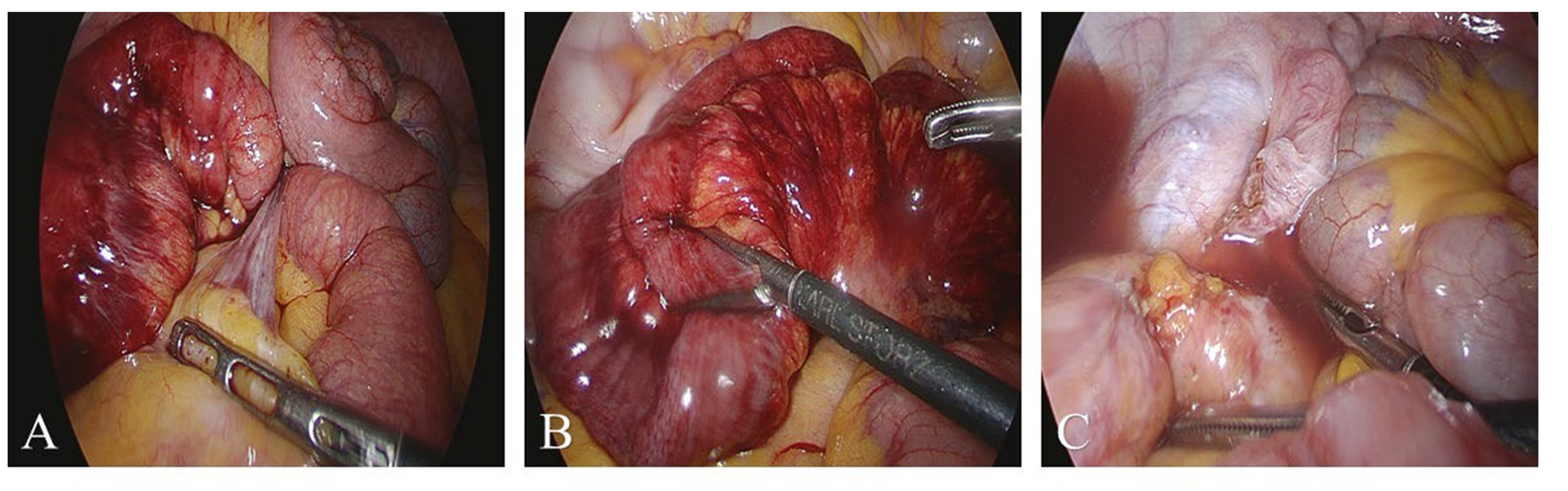 Images taken during
laparoscopic surgery. (A) An adhesive band between the sigmoid colon mesentery
and left ovary. (B) Congestion and swelling of the small intestine. (C)
Strangulation of the small intestine between the adhesive band.