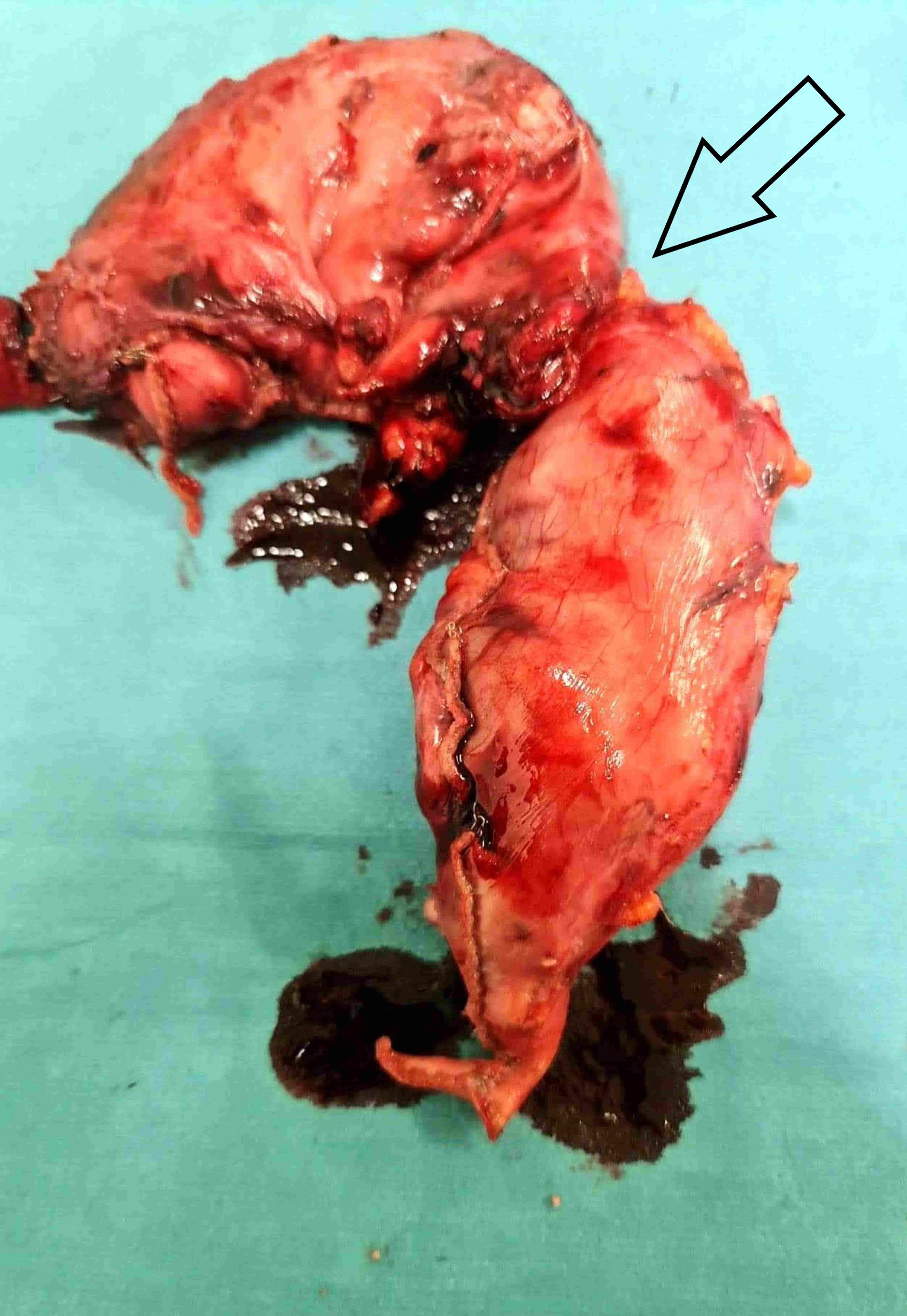 Removed portion of the 
patient’s stomach. The indentation marked with an arrow shows the earlier 
location of the hiatus esophagus.