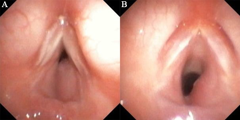 Evolution of bronchoscopy finding upon the therapy with
propranolol. (A) Initial bronchoscopy: confirmed diagnosis of subglottic
hemangioma. (B) Significant improvement at the end of the first week in the same
child.