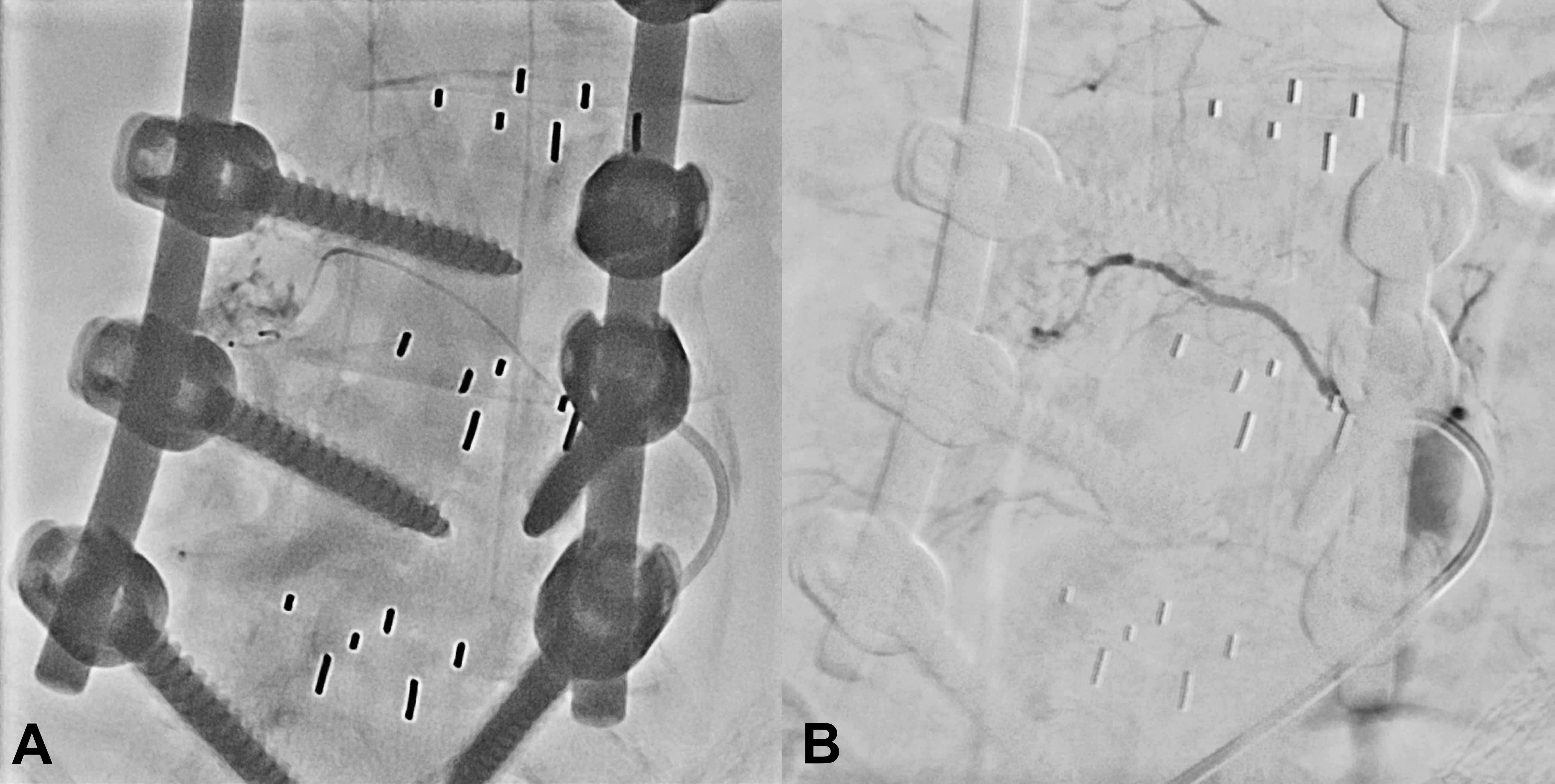 Angiography reveals an iatrogenic injury on the right side of
the fourth lumbar artery. (A) Before embolization and (B) after embolization.