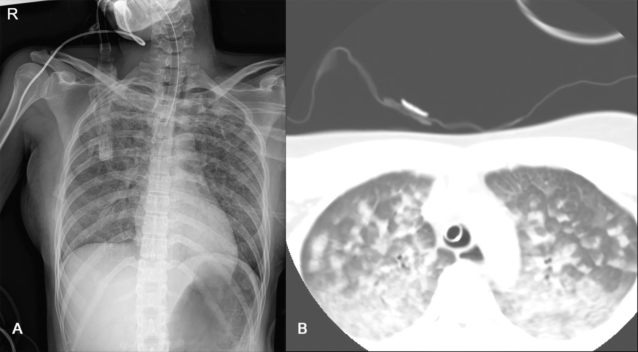 Radiologic results of neurogenic pulmonary edema. (A) Patient’s
chest radiography demonstrating diffuse bilateral infiltrations. (B) Lung setting
view from the bottom of the brain CT angiogram revealed significant pulmonary
edema compared to the chest plain radiograph. It is important to note that our
institution’s protocol for performing brain CT angiograms involves acquiring
images from the aortic root level.