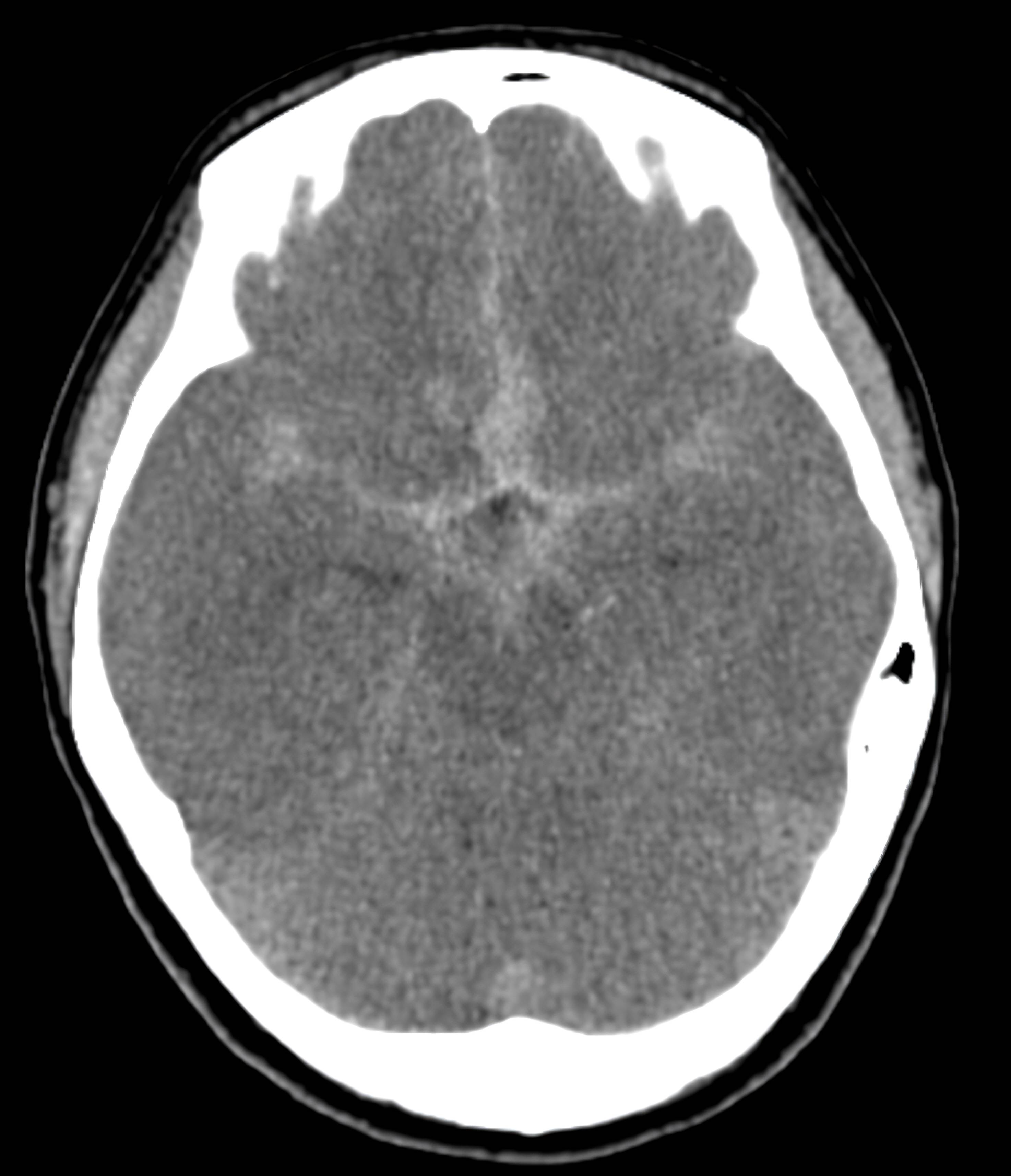 Axial slice of patient’s brain CT scan demonstrating the
presence of subarachnoid hemorrhage.