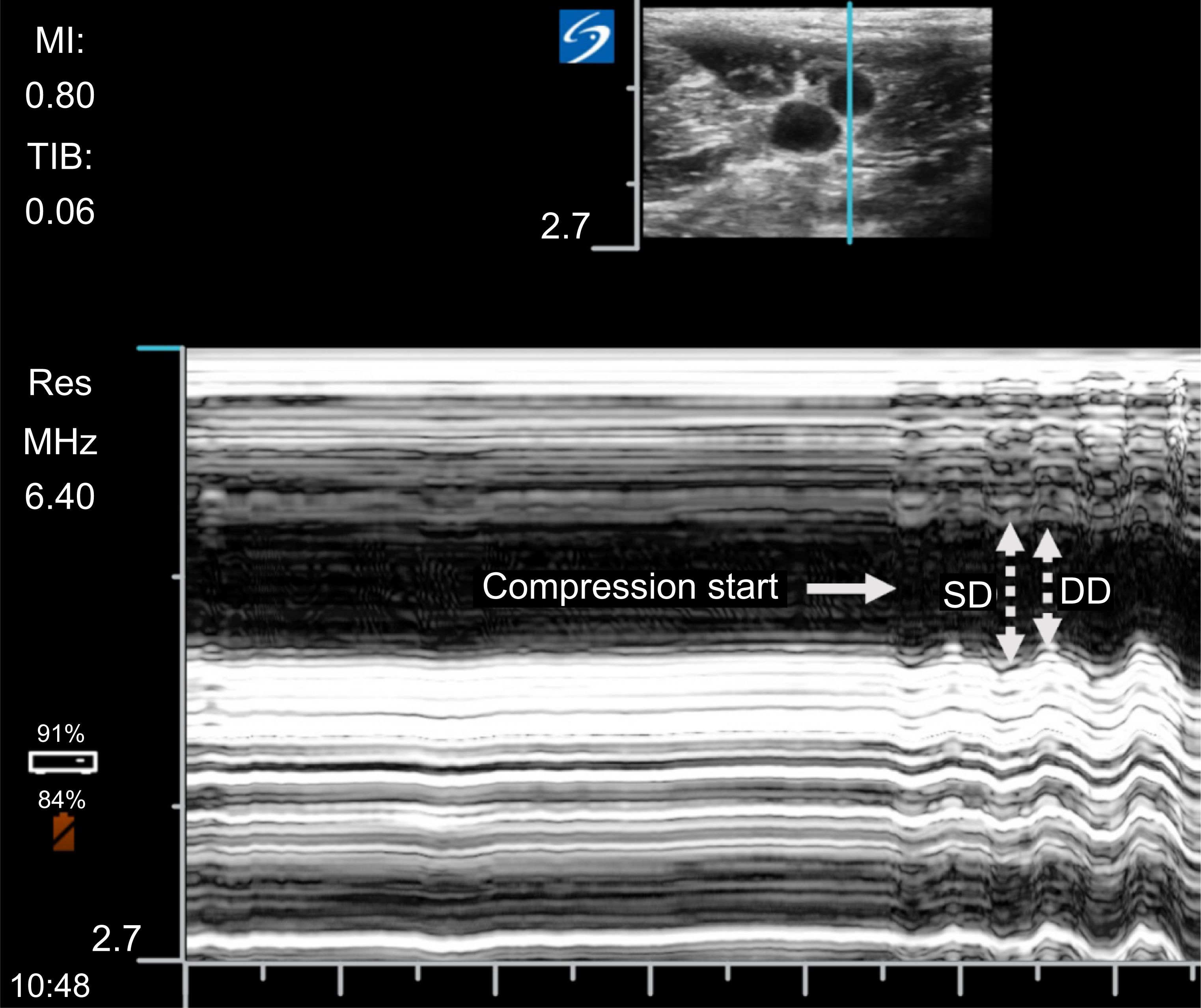 Measurement of systolic and diastolic diameter of femoral artery
by M-mode ultrasound. SD, systolic diameter; DD, diastolic diameter.