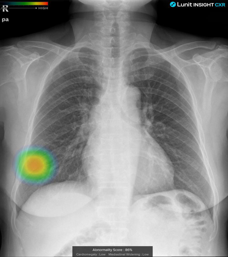 Example images of the computer aided detection system on chest radiograph. Heat
map on abnormal findings. The system provided abnormality score below the chest
radiograph with probability score. When probability score as 15% or greater, the
system interpreted a chest radiograph as an abnormal.