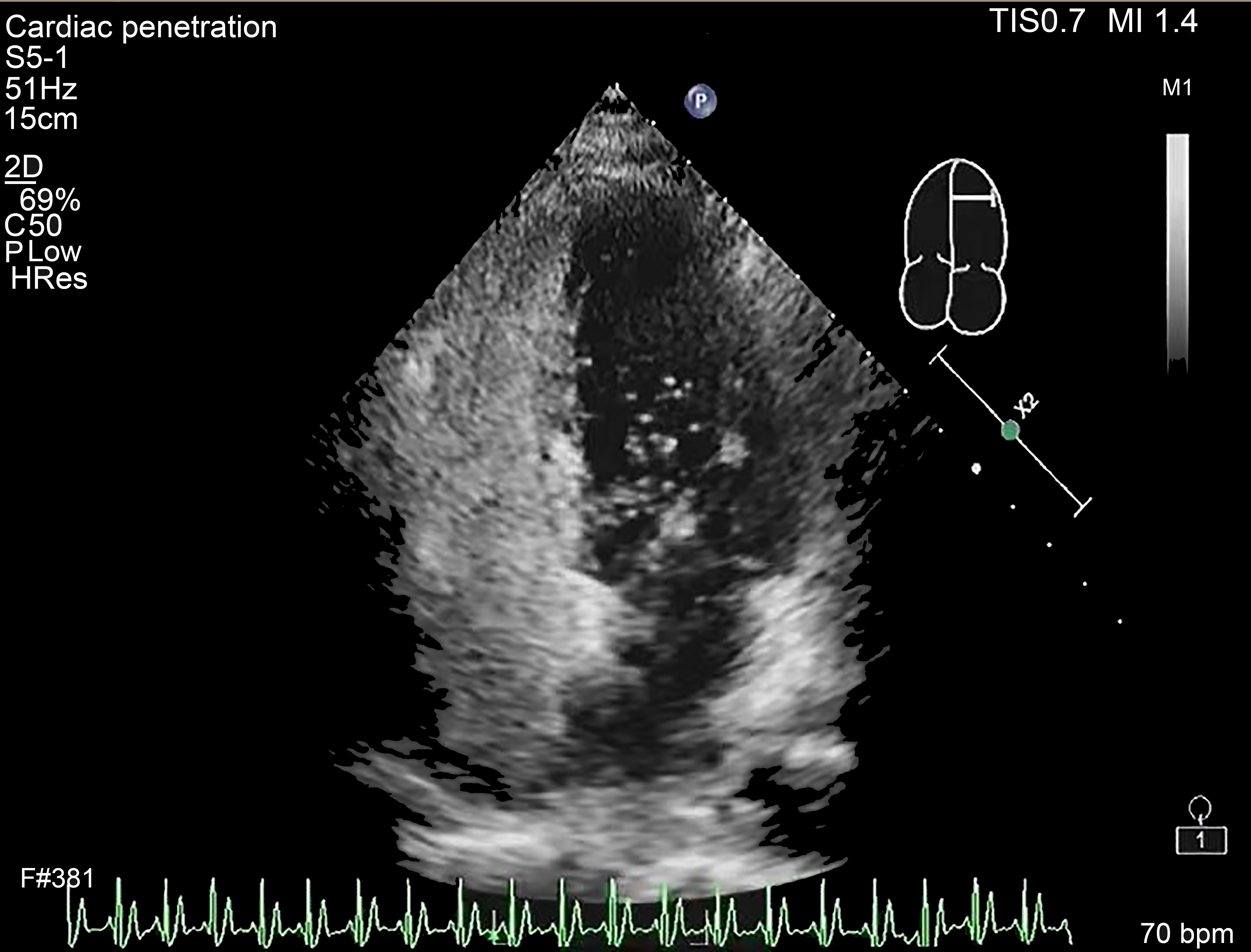 Right heart contrast echocardiography at rest.