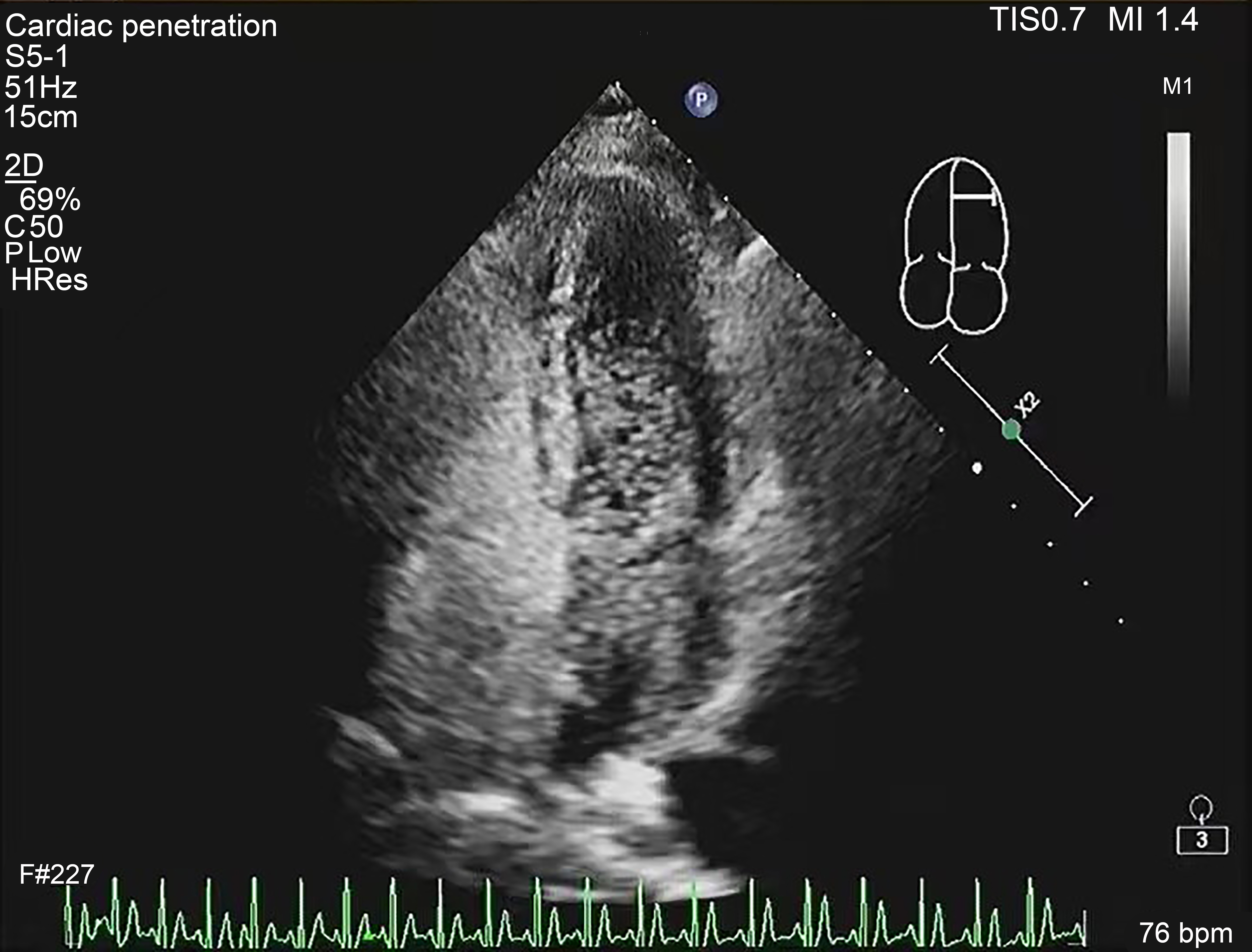 Right heart contrast echocardiography in Valsalva state.
