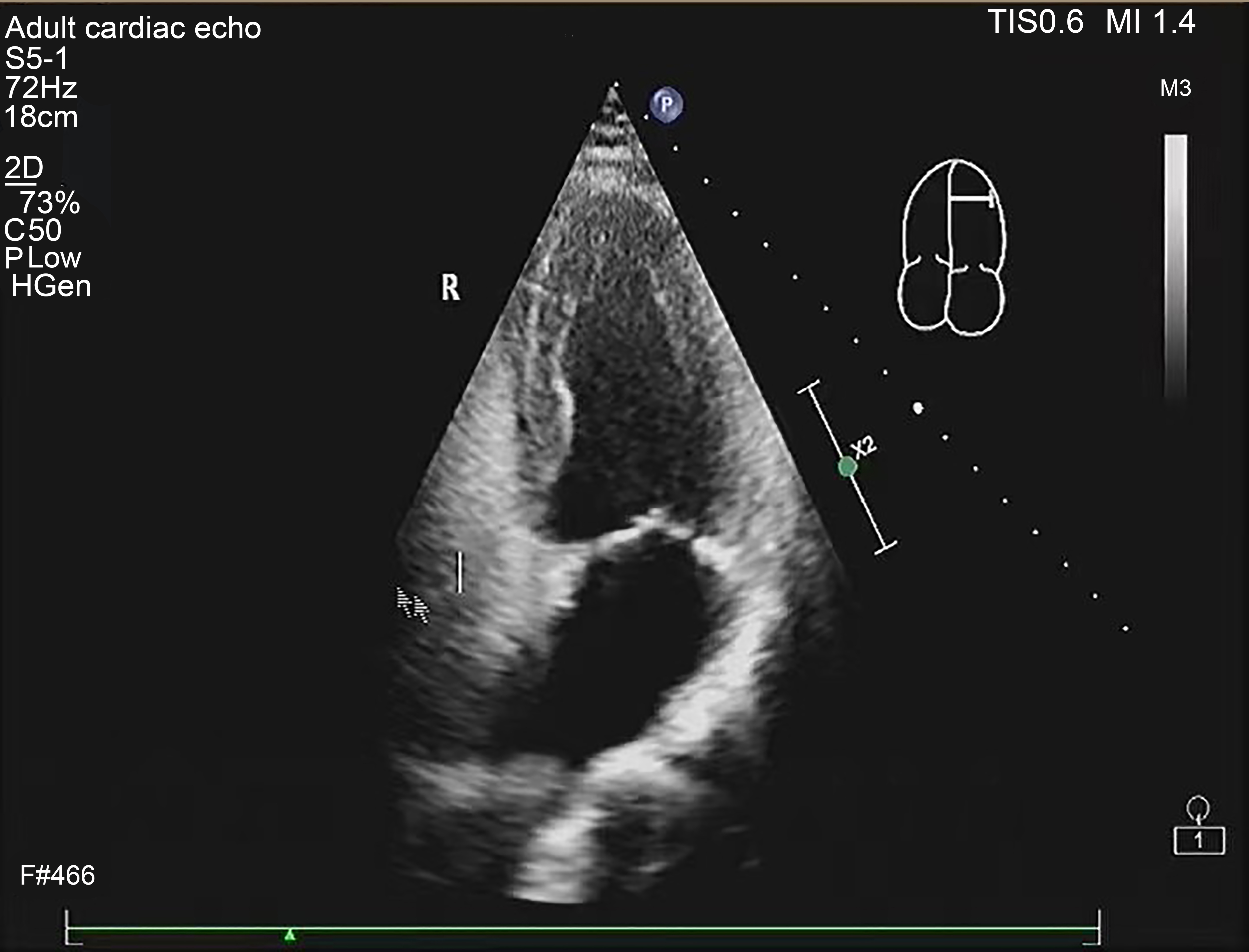 Right heart contrast echocardiography at rest.