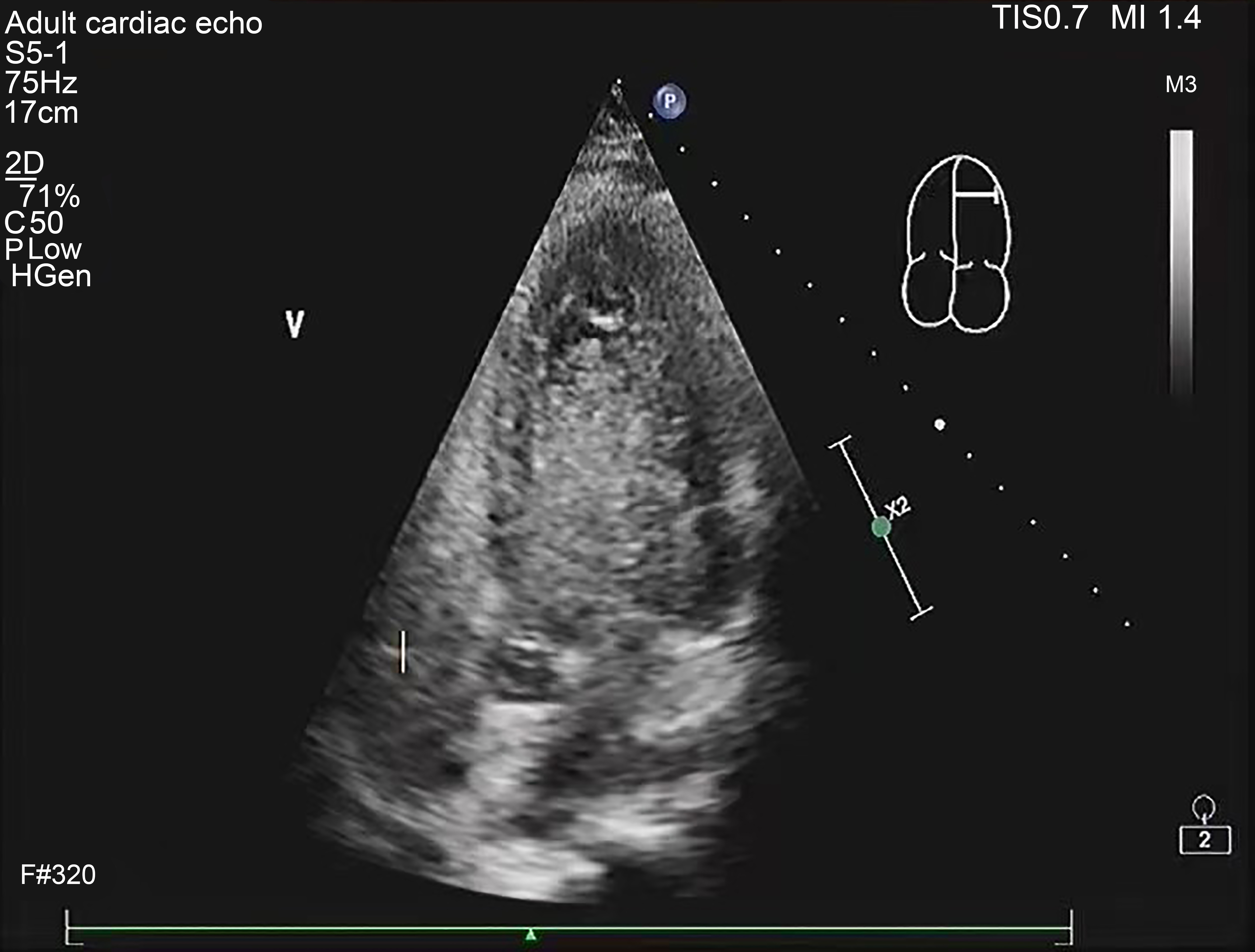 Right heart contrast echocardiography in Valsalva state.