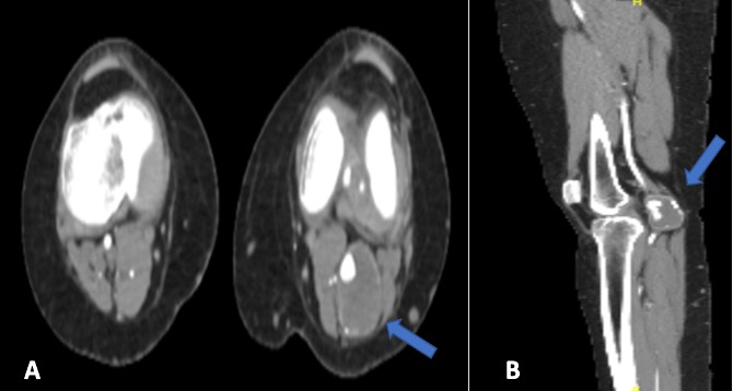 Computed tomography angiography of the lower limbs. (A) CTA axial section revealed a left popliteal artery aneurysm with a thrombosed
sac behind the knee joint (arrowhead), and distally, all runoff exhibited showed
good opacification. (B) CTA sagittal section of the same image.