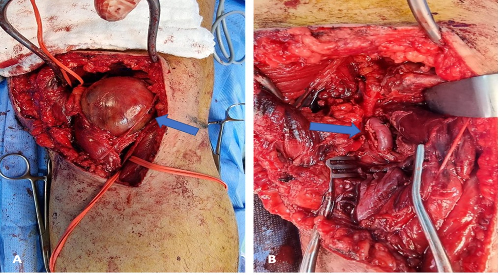 Intraoperative findings. (A) Posterior exploration of
the left popliteal artery, which revealed a large aneurysm confined to the
popliteal space (arrowhead). (B) Interposition vein graft end-to-end anastomosis
into the transected popliteal artery was performed (arrowhead).