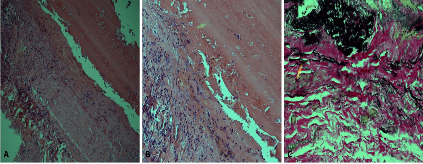 Histopathological examination. (A) Hematoxylin and
eosin staining (×100 magnification) and low-power microscopic view
revealing part of the aneurysm wall. Note the presence of fibrosis, scattered
chronic inflammatory cells, and a hyalinized fibrin thrombus in the upper right
side of this figure. (B) Hematoxylin and eosin staining (×200
magnification) and medium-power microscopic view revealing part of the aneurysm
wall. Note the presence of fibrosis, scattered chronic inflammatory cells, and a
hyalinized fibrin thrombus (arrowhead). (C) Elastica van Gieson staining
(×200 magnification) and photomicrograph representing a section obtained
from the aneurysm wall. The stain highlighted the marked fragmentation and
distortion of the elastic fibers (arrowhead) with the aneurysm wall.
