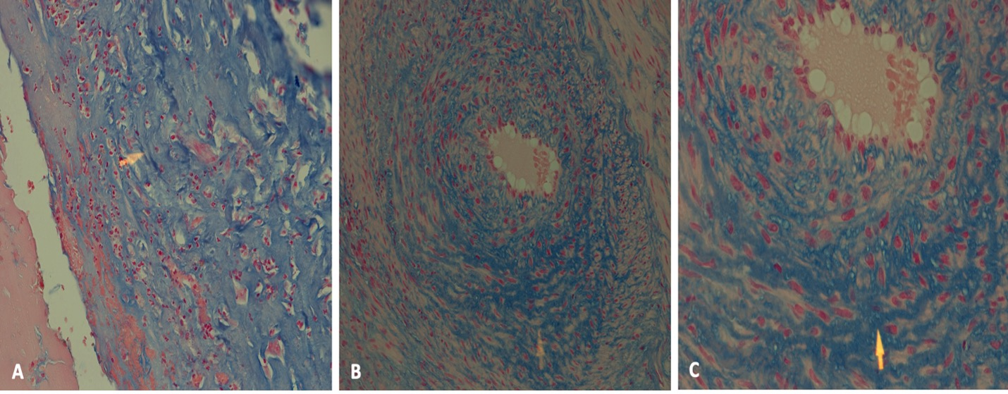 Histopathological examination using Alcian blue
staining. (A) Photomicrograph of Alcian blue staining (×200
magnification) revealing a section from the aneurysm wall. Note the presence of
marked mucoid material deposition in the aneurysm wall (arrowhead). (B)
Photomicrograph of Alcian blue staining (×200 magnification) disclosing
a medium-sized arteriole near the aneurysm. Note the presence of extensive mucoid
deposition with the intima and media of the artery (arrowhead). (C)
Photomicrograph of Alcian blue staining (×400 magnification) revealing a
medium-sized arteriole near the aneurysm. Note the presence of extensive mucoid
deposition with the intima and media of the artery (arrowhead).