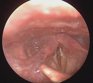 A laryngoscope image of the patient obtained 3 days after
surgery. Small erosion is seen in the patient’s left vocal cord, and bilateral
vocal cord paralysis is partially improved.