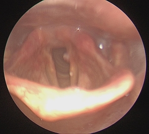 A laryngoscope image of the patient obtained 3 months after
surgery. The patient’s vocal cord movement is recovered and symmetric. This
image was taken at the outpatient clinic’s follow-up 3 months after the surgery.