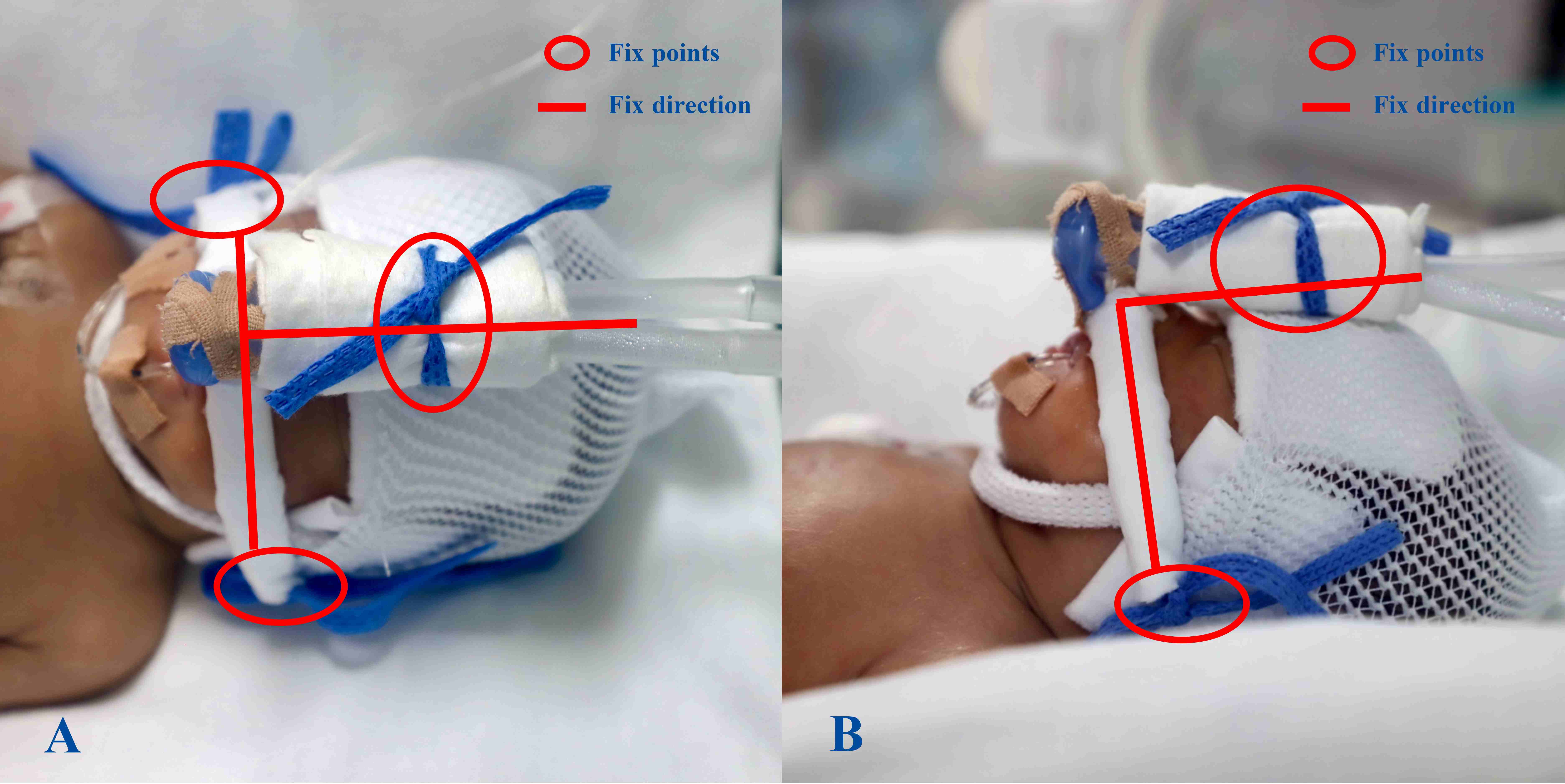 Standardized method for
nasal prong/mask wearing. The standardized method for nasal prong/mask wearing is
as follows: (a) The ventilator tube is fixed at a point on the forehead of the
newborn. In addition, the tube is positioned along the midline of the body. (b)
The nasal prong/mask fixation cord is fixed behind both ears so that the three
points, namely, the fixation points on the left and right and the nasal
prongs/mask position, align parallel with the horizontal planes of the human
body. (c) The ventilator circuit line is perpendicular to the line formed by
these three points, namely, the fixation points on the left and right and the
position of the nasal prongs/mask, in the human coronal plane (A). (d) The
ventilator circuit line is perpendicular to the line of the aforementioned three
points in the human sagittal plane (B). (e) The elastic hat edges in contact with
the skin are padded with cotton wool to disperse the pressure.