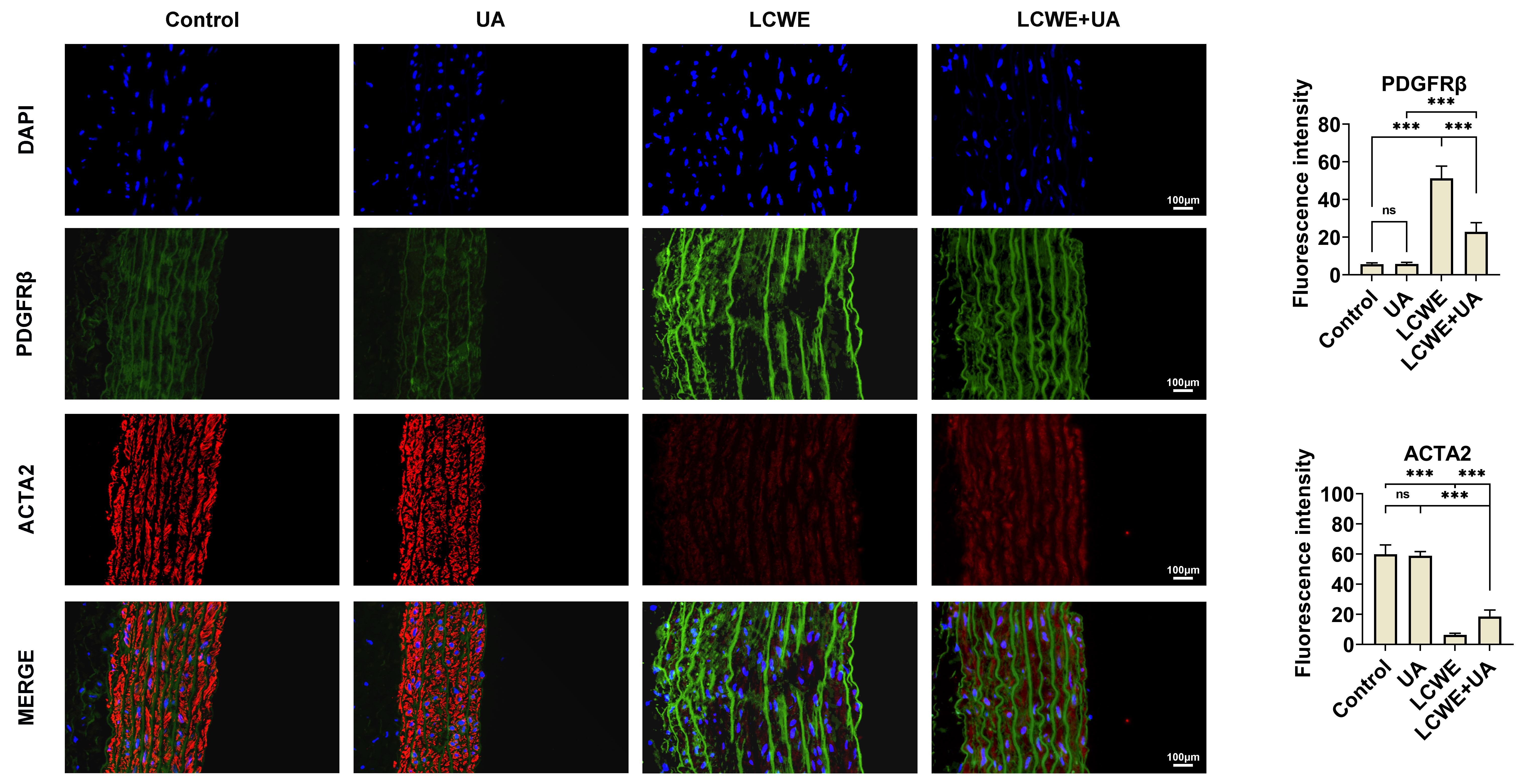 Ursolic acid inhibits VSMC dedifferentiation. Immunostaining
assays showed the expression and location of ACTA2 (red panel) and PDGFRβ
(green panel) in mice’ aorta tissues in the Control, UA (80 mg/kg), LCWE and LCWE
+ UA groups. Scale bar indicates 100 μm. ***p < 0.001. LCWE: lactobacillus casei
cell wall extract; ACTA: beta-actin, PDGFRβ: Platelet-Derived Growth
Factor Receptor Beta; DAPI: 4′,6-diamidino-2-phenylindole; UA: Ursolic acid, ns:
no significant.