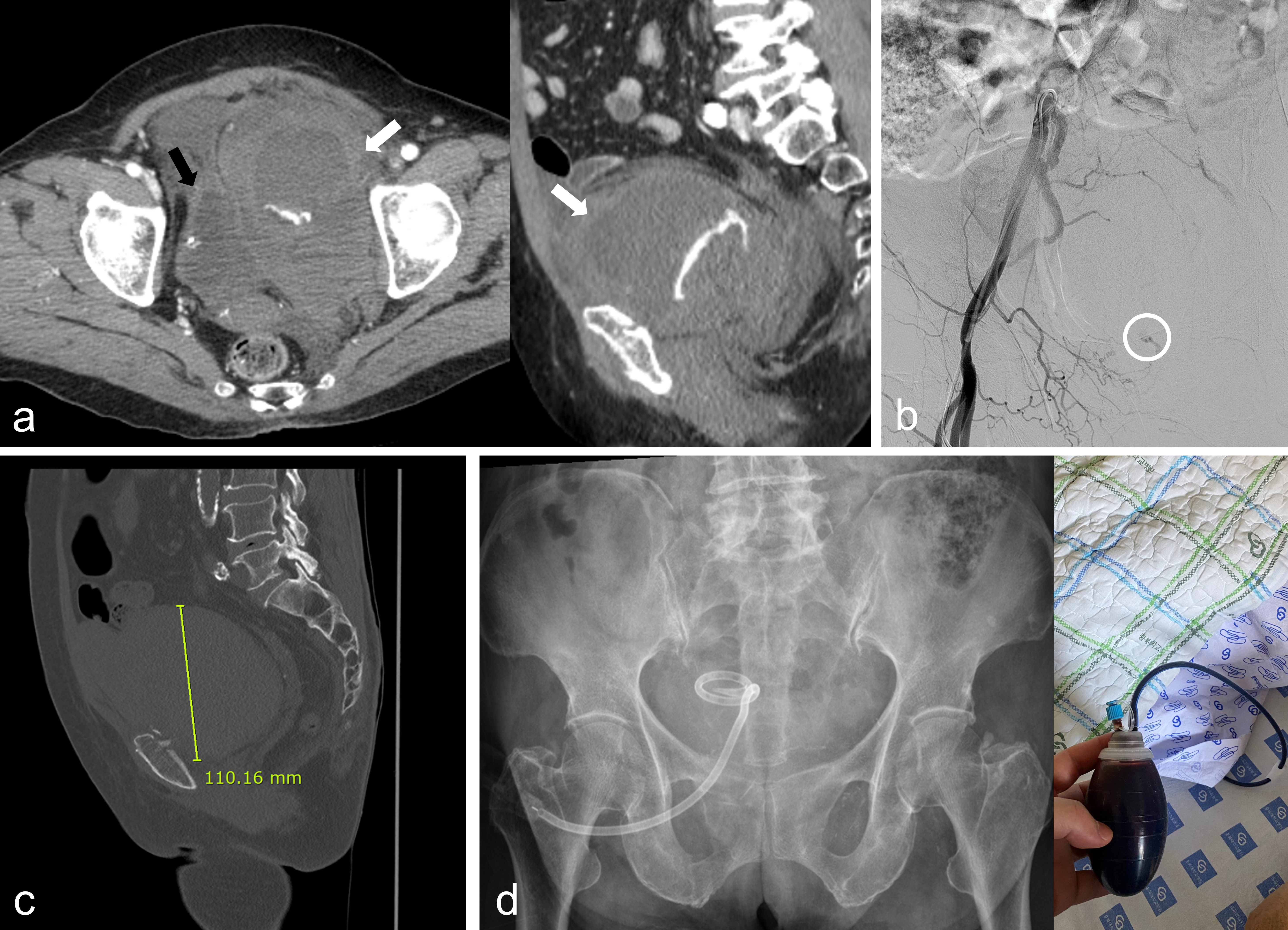 Case example. A female patient aged 78 years injured from a
fall was admitted to the emergency department with a systolic blood pressure of
80 mmHg. (a) An enhanced abdominal CT scan demonstrated extravasation, resulting
in a huge hematoma (white arrow), which extends beyond the midline while
compressing the urinary bladder (black arrow). (b) Angiography of the external
iliac artery revealed active bleeding of the aberrant obturator artery (white
circle), which was controlled with embolotherapy. (c) One week
after the injury, pelvic CT revealed a huge hematoma with a rim distance of 110
mm. (d) Symptomatic hematoma was drained with a percutaneous pigtail catheter,
and the abdominal discomfort improved.