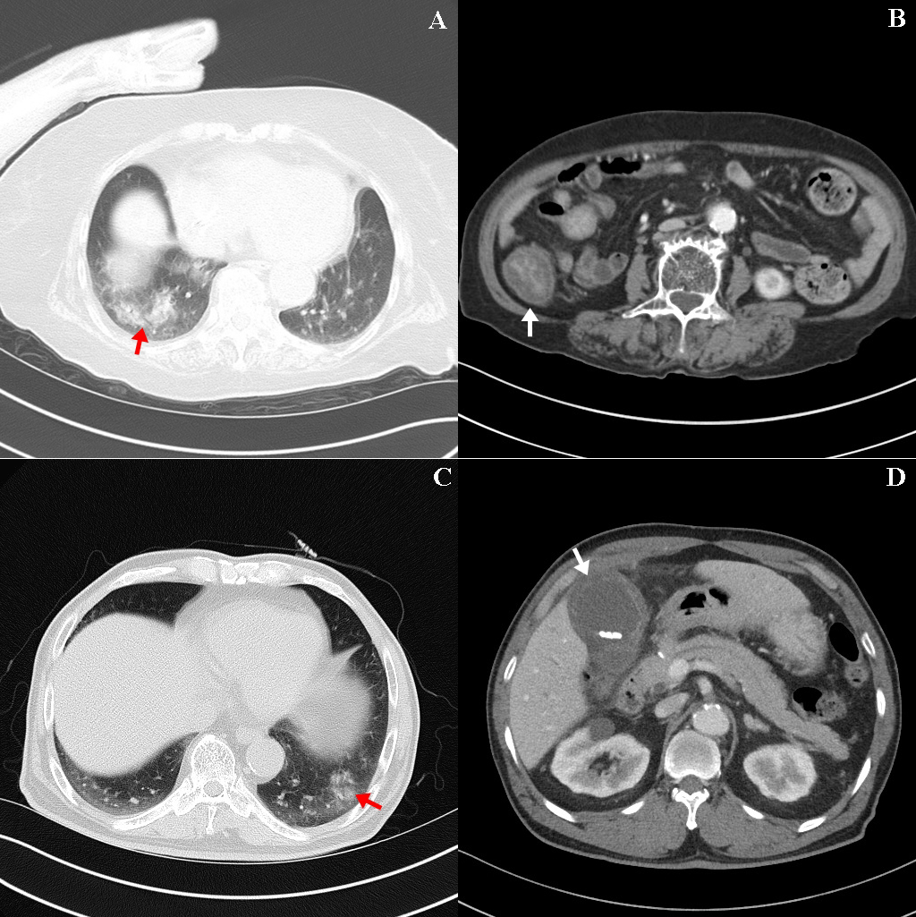 Examples of co-infection sources on combined chest and abdominal
CT in this study. (A,B) show co-infection sources of pneumonia (red
arrow—patchy consolidation in right lower lobe) and colitis (white
arrow—edematous wall thickening of ascending colon) in an 87-year-old woman.
(C,D) show pneumonia (red arrow—focal, peri-bronchial ill-defined
consolidation) and acute cholecystitis (white arrow—thick enhance gall bladder
wall and multiple stones) in a 72-year-old man.