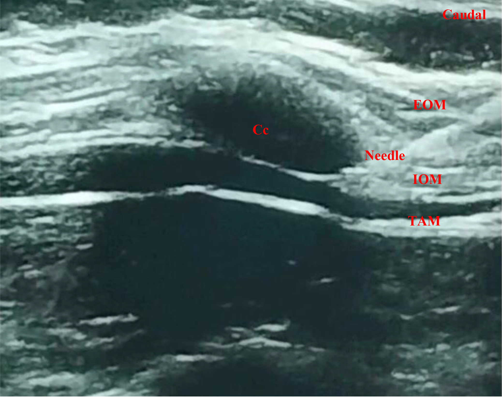 M-TAPA block; Reverse ultrasound anatomy. Cc: Costal Cartilage; 
EOM: External Oblique Muscle; IOM: Internal Oblique Muscle; TAM: Transversus 
Abdominis Muscle.