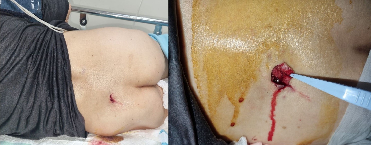 An inverted U-shaped laceration observed on the left lower back
and does not appear deep.