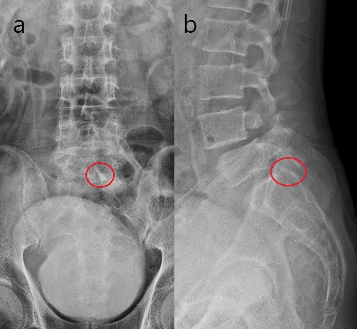 A radiopaque signal observed in a red circle on the lumbar
radiograph. (a) lumbar anterior posterior view, (b) lumbar lateral view.