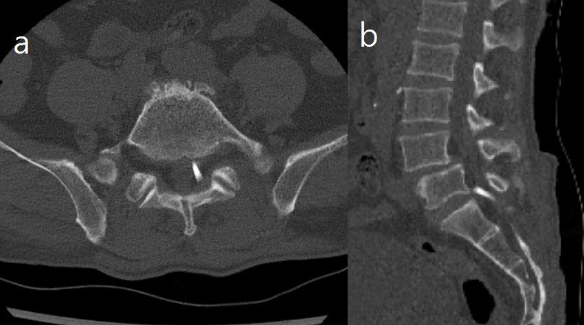 Computed tomography showing a high-density foreign body in the
L5/S1 spinal canal. (a) axial view, (b) sagittal view.
