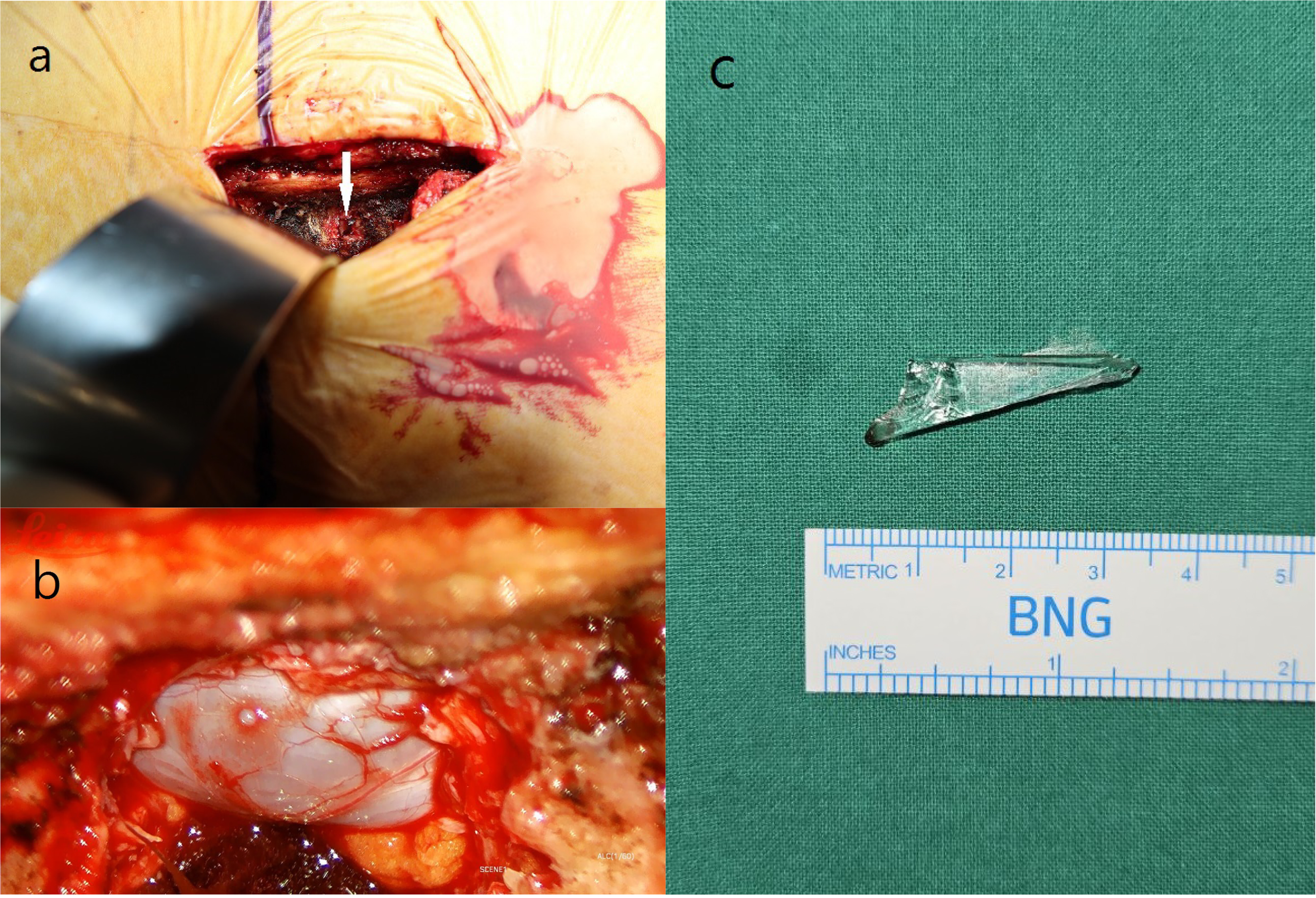 Operative findings. (a) A glass foreign body observed in the
L5/S1 interlaminar space (white arrow). (b) No dural tear observed under
microscopic examination after the foreign body removal. (c) A glass fragment of
approximately 3 cm × 1 cm.