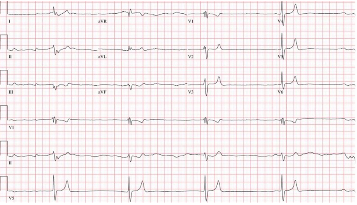 ECG at the time of admission to the emergency room.