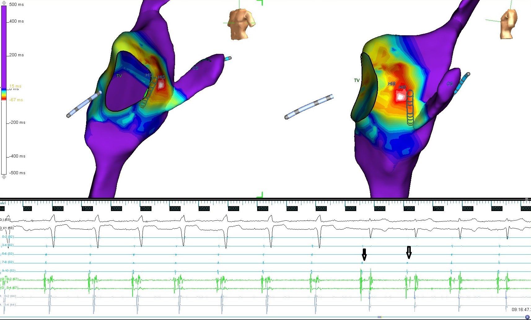 The delta mapping in sinus rhythm of a patient with a manifest
parahisian accessory pathway is shown. The earliest activated region was the
parahisian region. A mechanical bump has been shown in the accessory pathway,
while the 6-mm-tipped cryoablation catheter comes to the early activation area
detected with the diagnostic catheter. His signal after the mechanical bump is
indicated by arrows. Successful cryoablation was applied to the same location. TV: Tricuspid valve; HIS: His bundle; CS: coronary sinus.