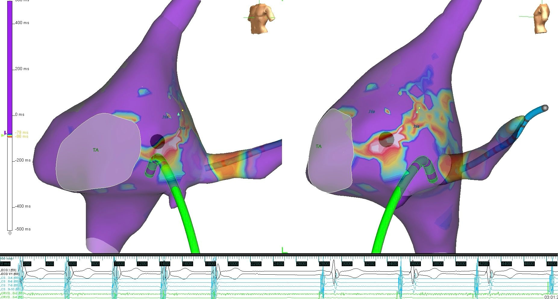 The moment when the concealed accessory pathway-dependent
tachycardia stops during cryoablation is shown. TA: Tricuspid annulus; His: His
bundle.