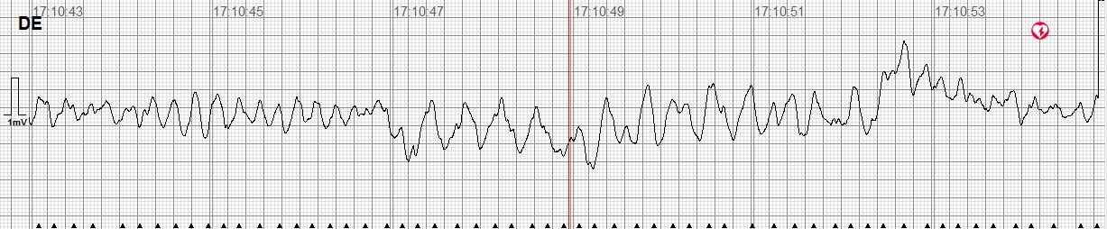 Illustration of 10-second ventricular fibrillation strips used for
amplitude spectrum area analysis. DE: Deutschland (screen device
inscription).