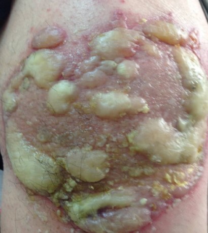 Plant-related chemical burns (phytodermatitis).