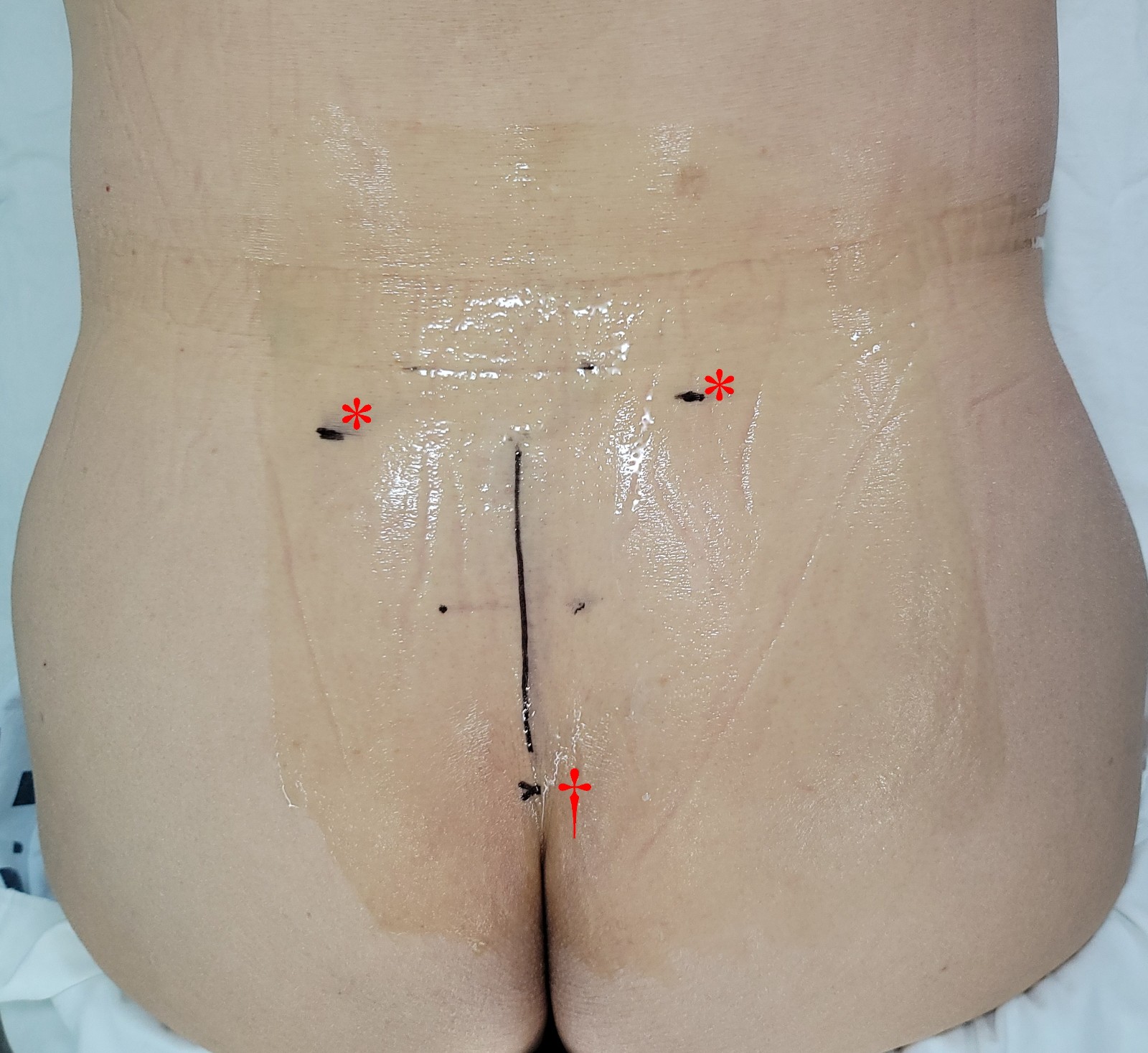 Sacral surface landmarks. *: posterior superior iliac spine on both sides; †: coccyx.