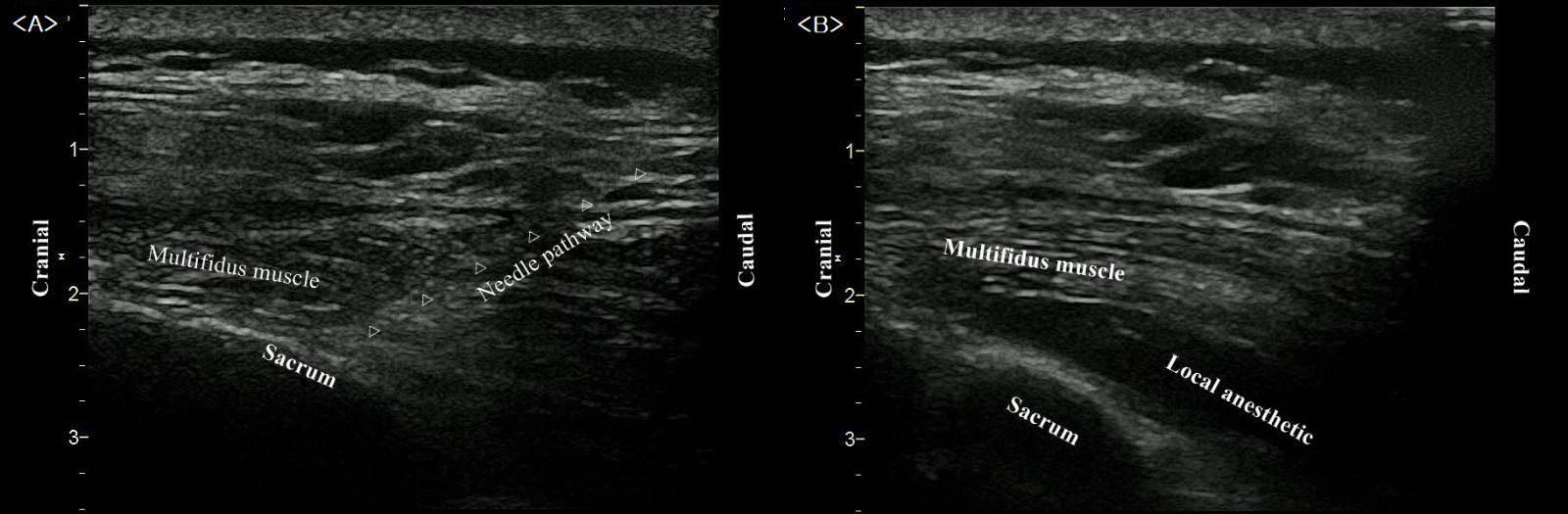 Ultrasound image of the sacral multifidus plane block. (A)
Needle pathway toward the sacrum in a caudocranial direction. (B) Upward lifting
of the multifidus muscle after injecting local anesthetics.