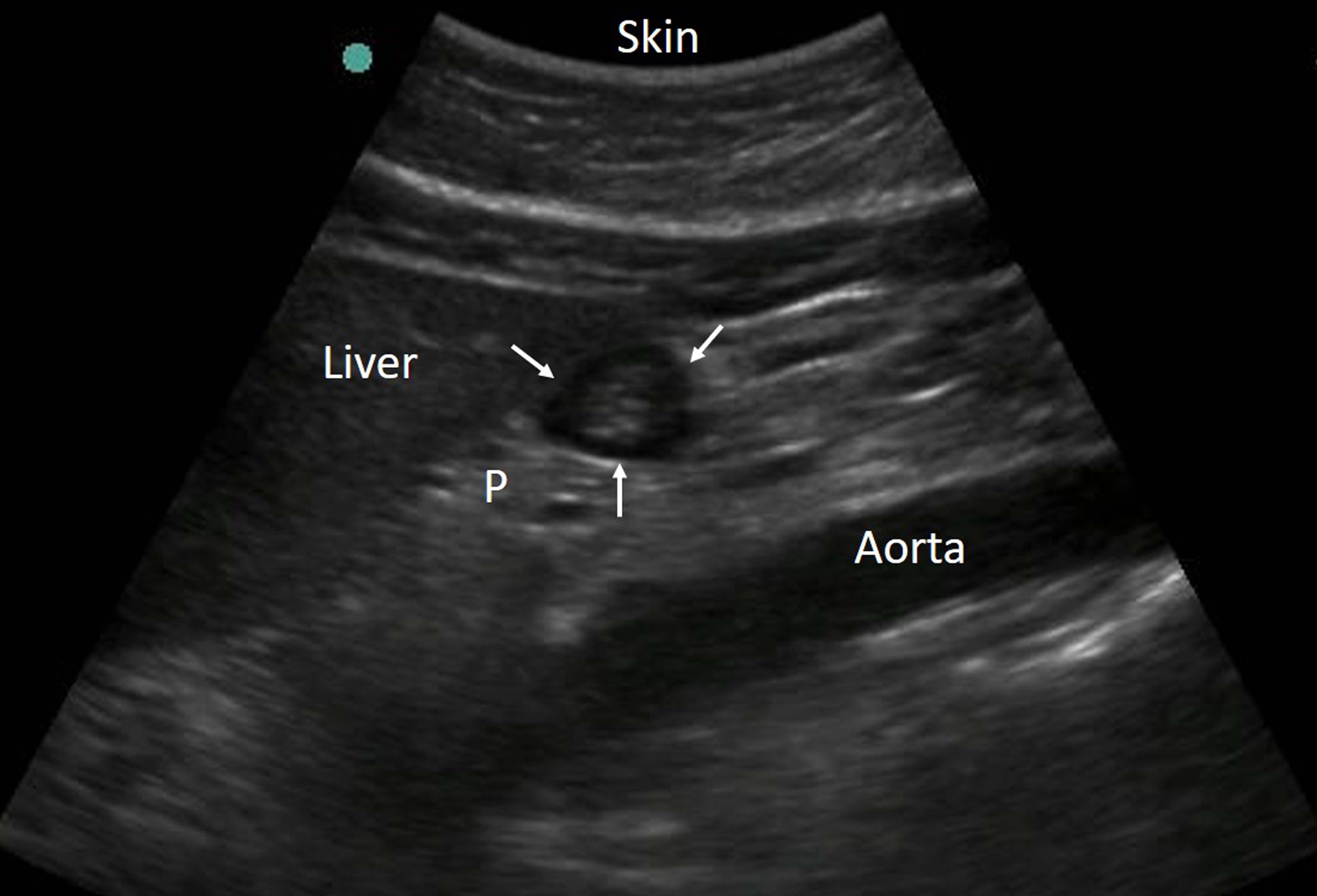 Ultrasound image of the gastric antrum in the epigastric area
obtained in a sagittal or parasagittal plane. The arrows indicate the gastric
antrum. P, pancreas.