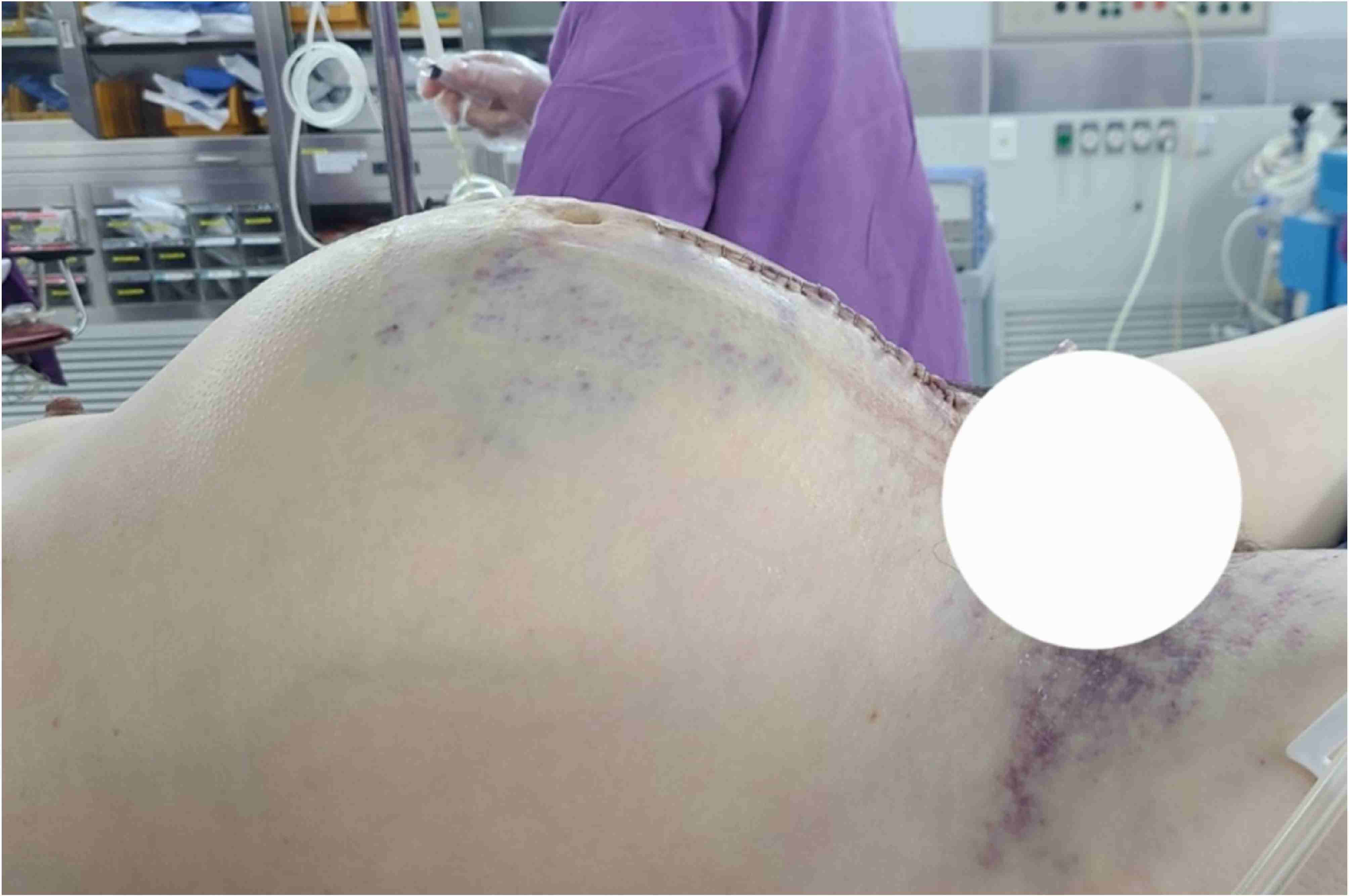 Image showing the worsening of the abdominal compartment
syndrome 2 days after a total hysterectomy.