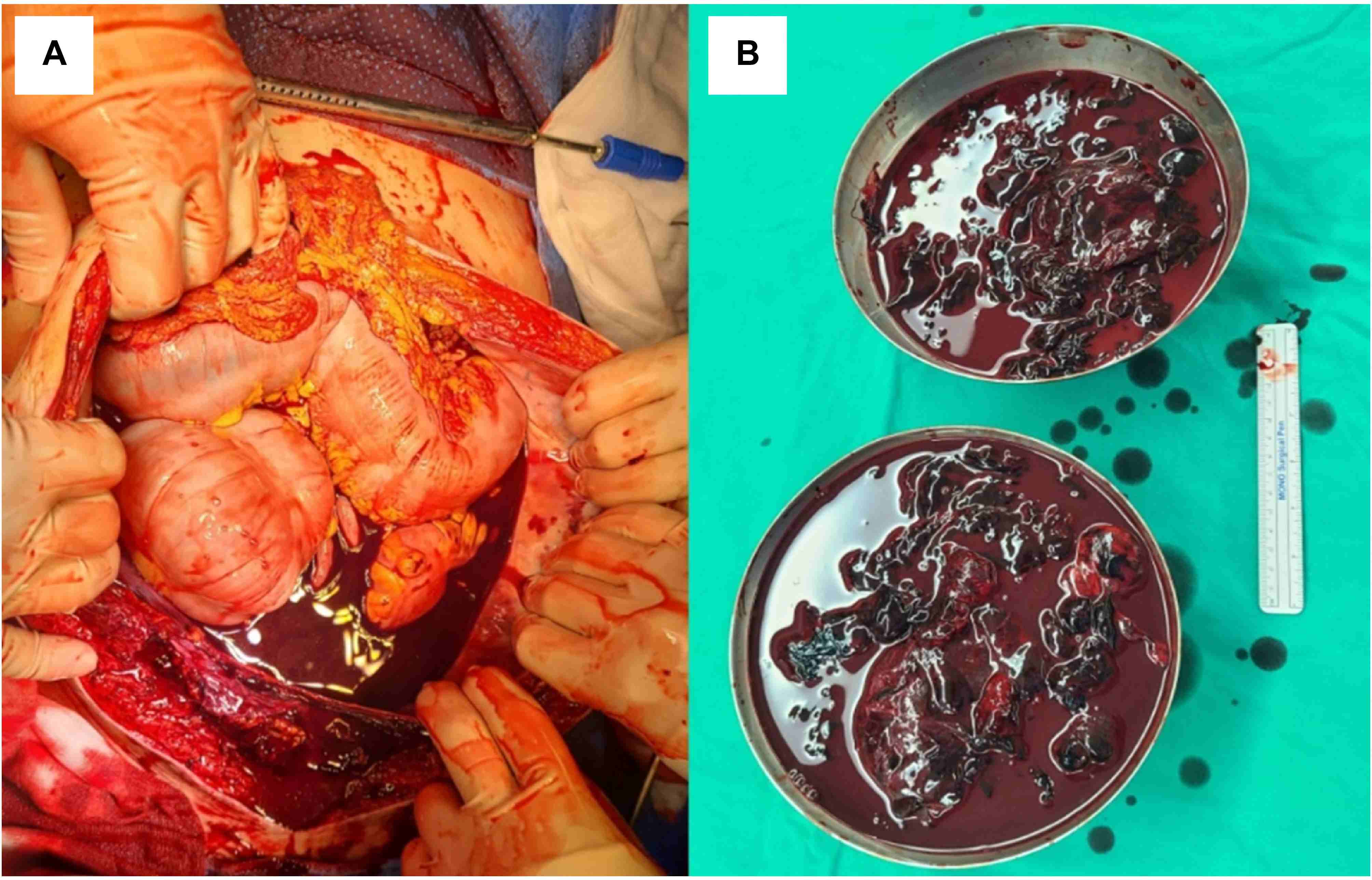 Intraoperative clinical photograph. (A) The surgical
decompression procedure performed for the abdominal compartment syndrome
resulting from hemorrhage induced by disseminated intravascular coagulation
(DIC). (B) The hematoma that was evacuated.