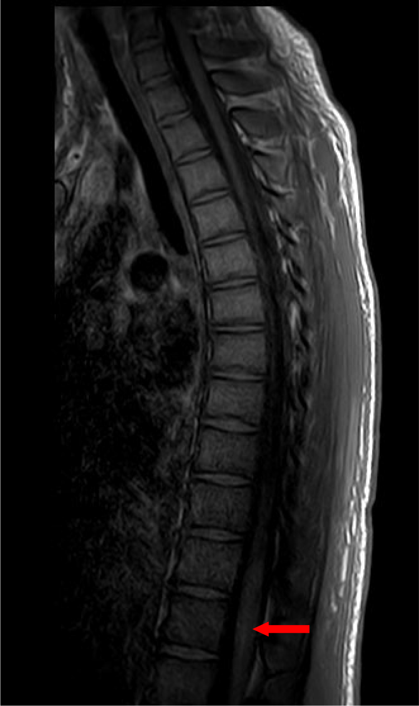 MRI T1 signal of the lumbar spine shows swelling of the conus 
medullaris segment of the spinal cord.