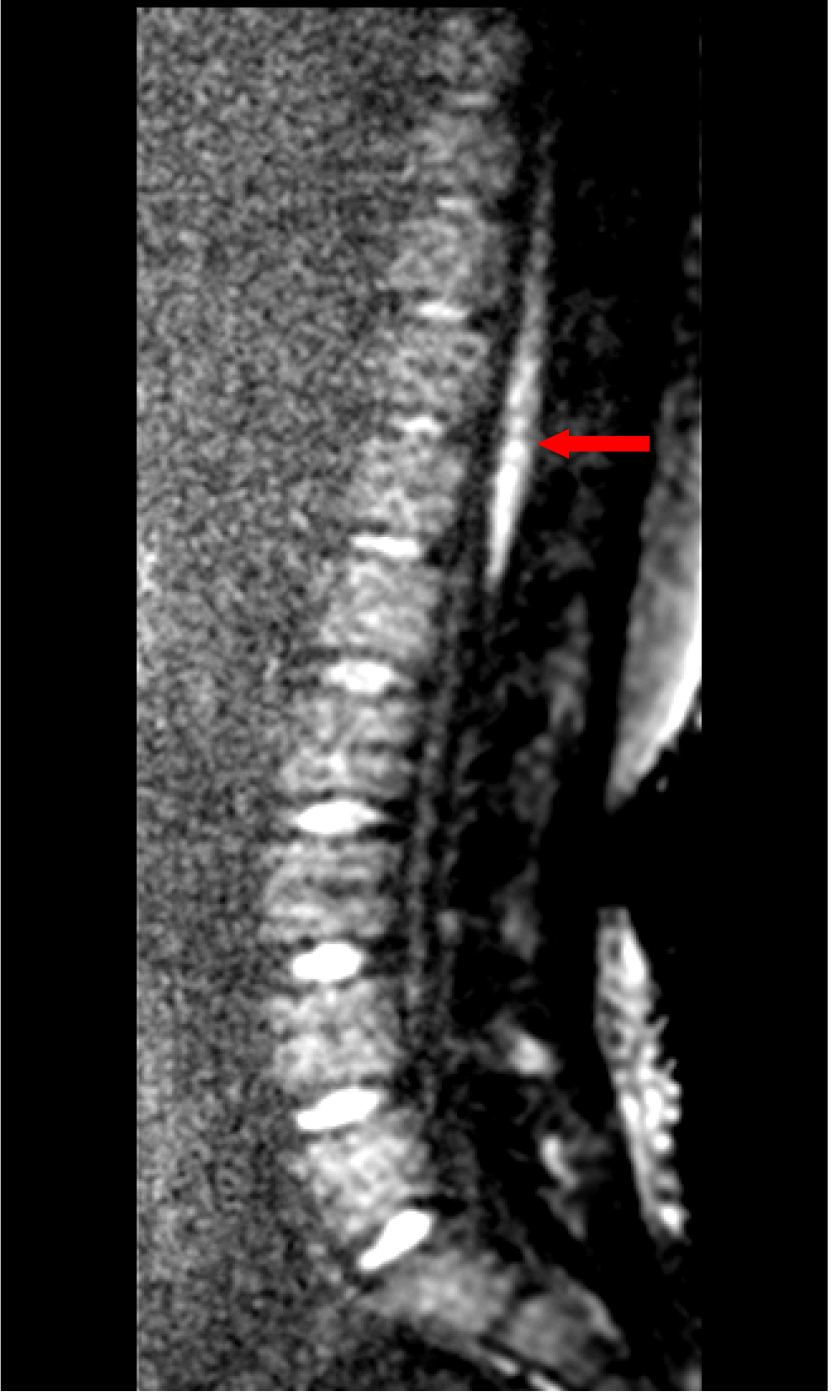 MRI T2 signal of the lumbar spine shows swelling of the conus 
medullaris segment of the spinal cord, and the signal is enhanced.