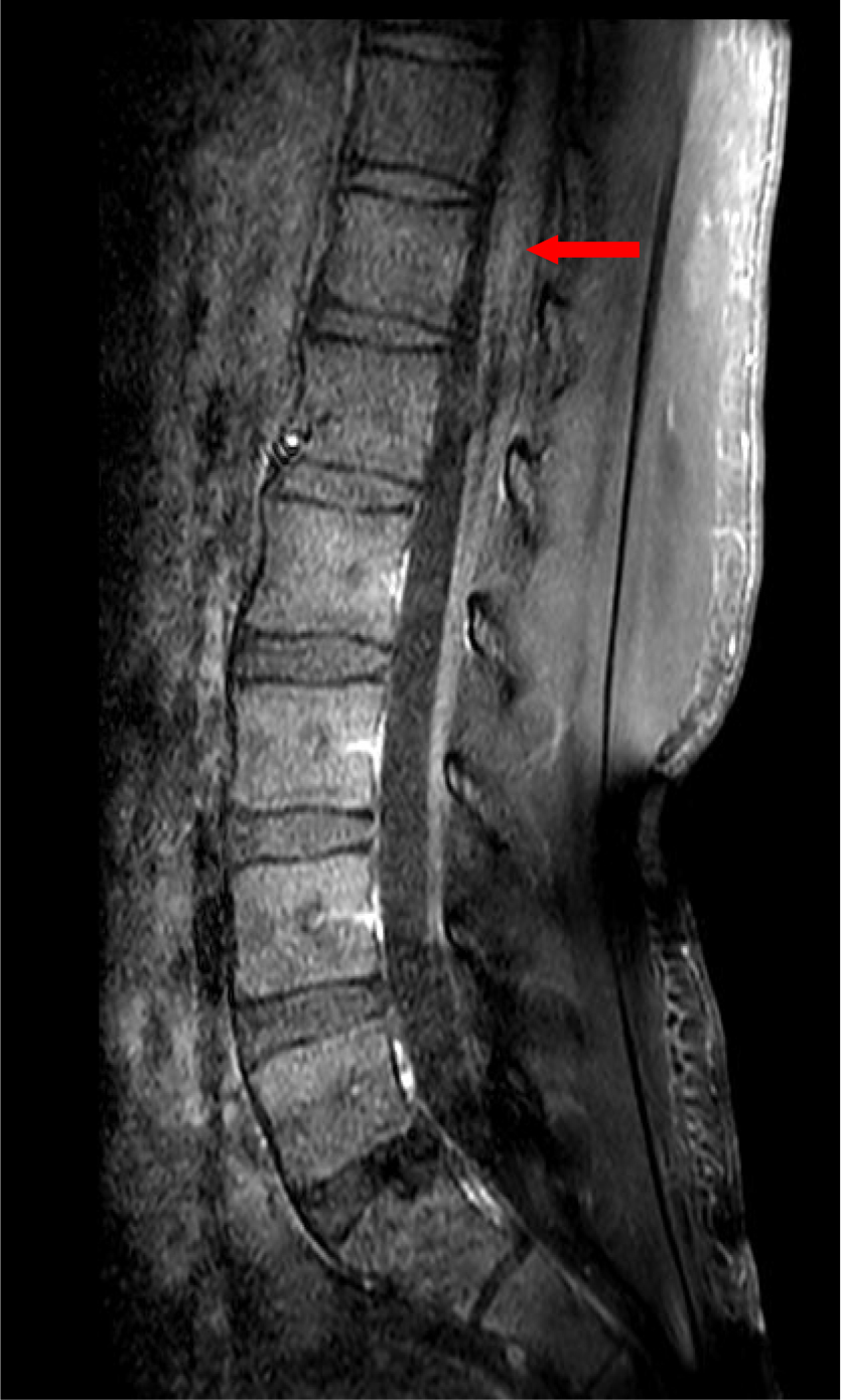 MRI enhancement of the lumbar spine showed no enhancement signal 
of the spinal cone.