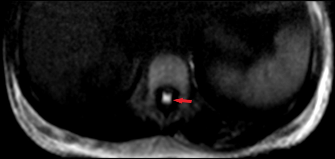 MRI cross-sectional DWI of the lumbar spine shows enhanced 
spinal conus medullaris segment signaling.