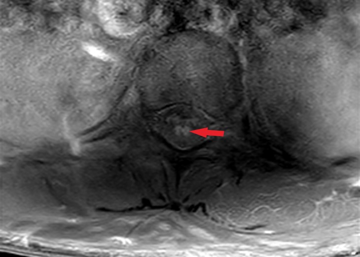 MRI transection of the lumbar spine showed no enhanced signal of 
the spinal cord cone.