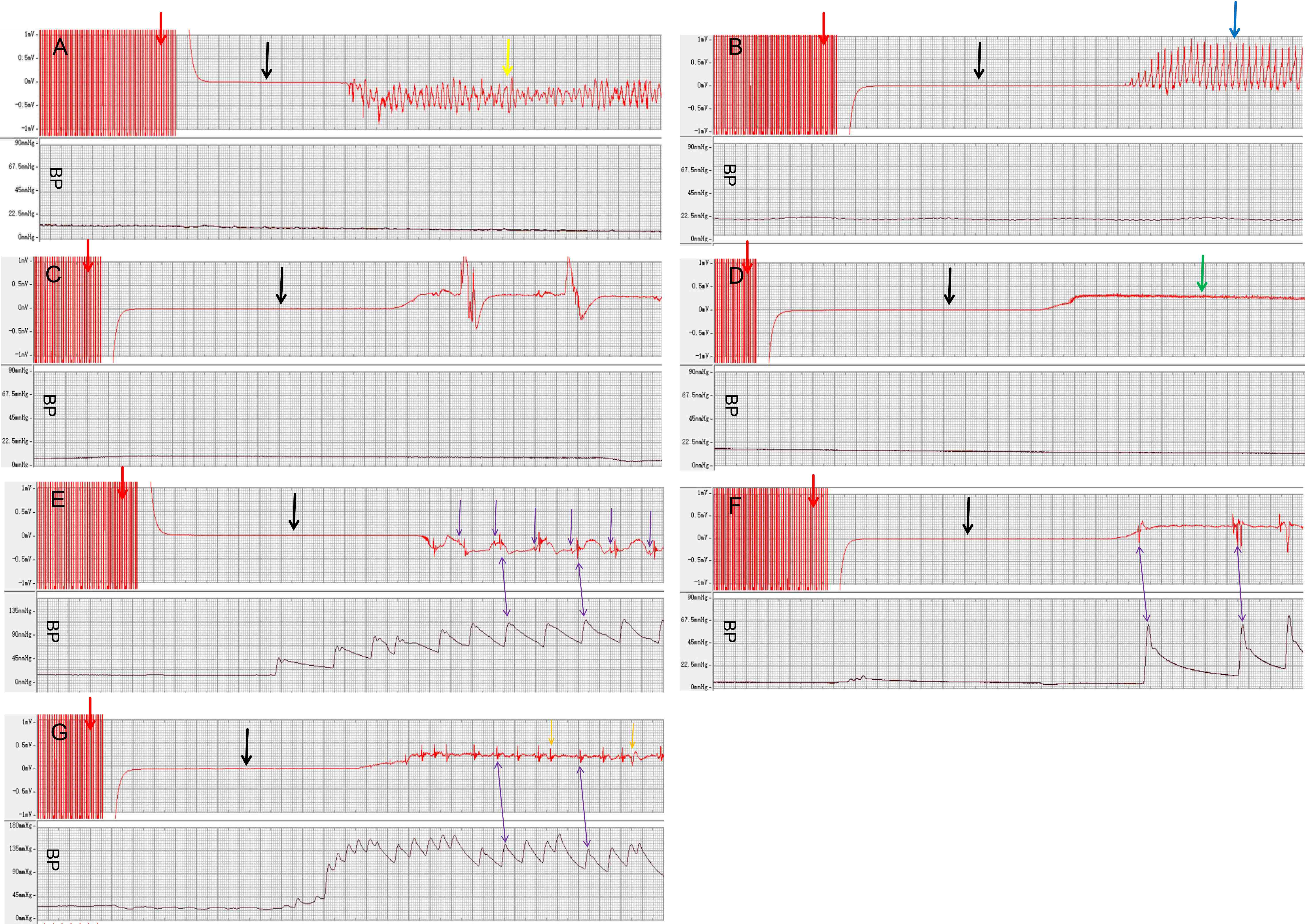 ECG wave and arterial pulse wave after electrical stimulation.
Following the cessation of electrical stimulation (red arrow), an ECG blind
period lasting approximately 5 s was observed (black arrow). Subsequently, the
ECG demonstrated various arrhythmias: (A) VF (yellow arrow), (B) pulseless VT
(blue arrow), (C) PEA, (D) asystole (green arrow), (E) sinus bradycardia, (F)
escape rhythm, and (G) premature beats (orange arrow). (A–D) were occurring
with blood pressure (BP) below 25 mmHg, while (E–G) were occurring with BP
above 60 mmHg. The purple arrow represents the P wave, and the double purple
arrow represents that the QRS wave peak is related to systolic pressure. Abbreviations: ECG, electrocardiogram; VF, ventricular fibrillation; VT,
ventricular tachycardia; PEA, pulseless electrical activity; BP, blood pressure.