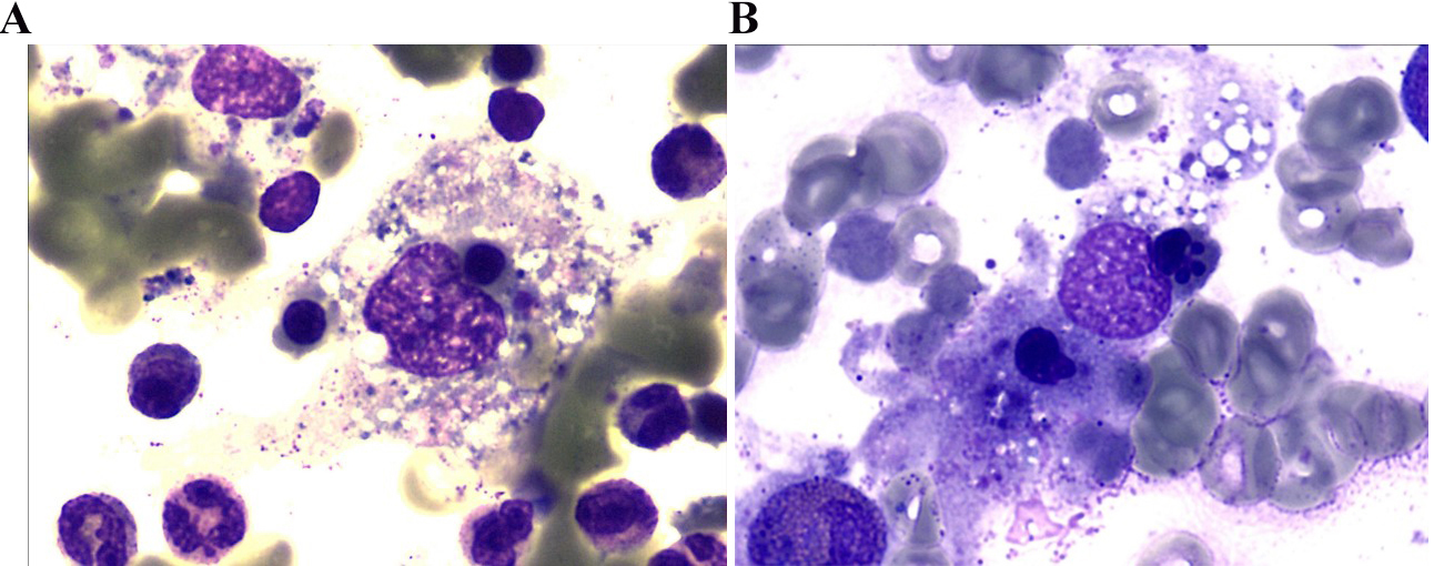 Monocyte-phagocytic cells in bone marrow cytological smear. 
Morphological examination of bone marrow cells demonstrated the presence of 
mononuclear and phagocytic histiocytes. (A) Monocytes phagocytosing platelets and 
mature erythrocytes. (B) Monocytes phagocytosing lymphocytes, neutrophils and 
mature erythrocytes. Staining was performed using Wright-Giemsa, captured at 10 
× 100 magnification.