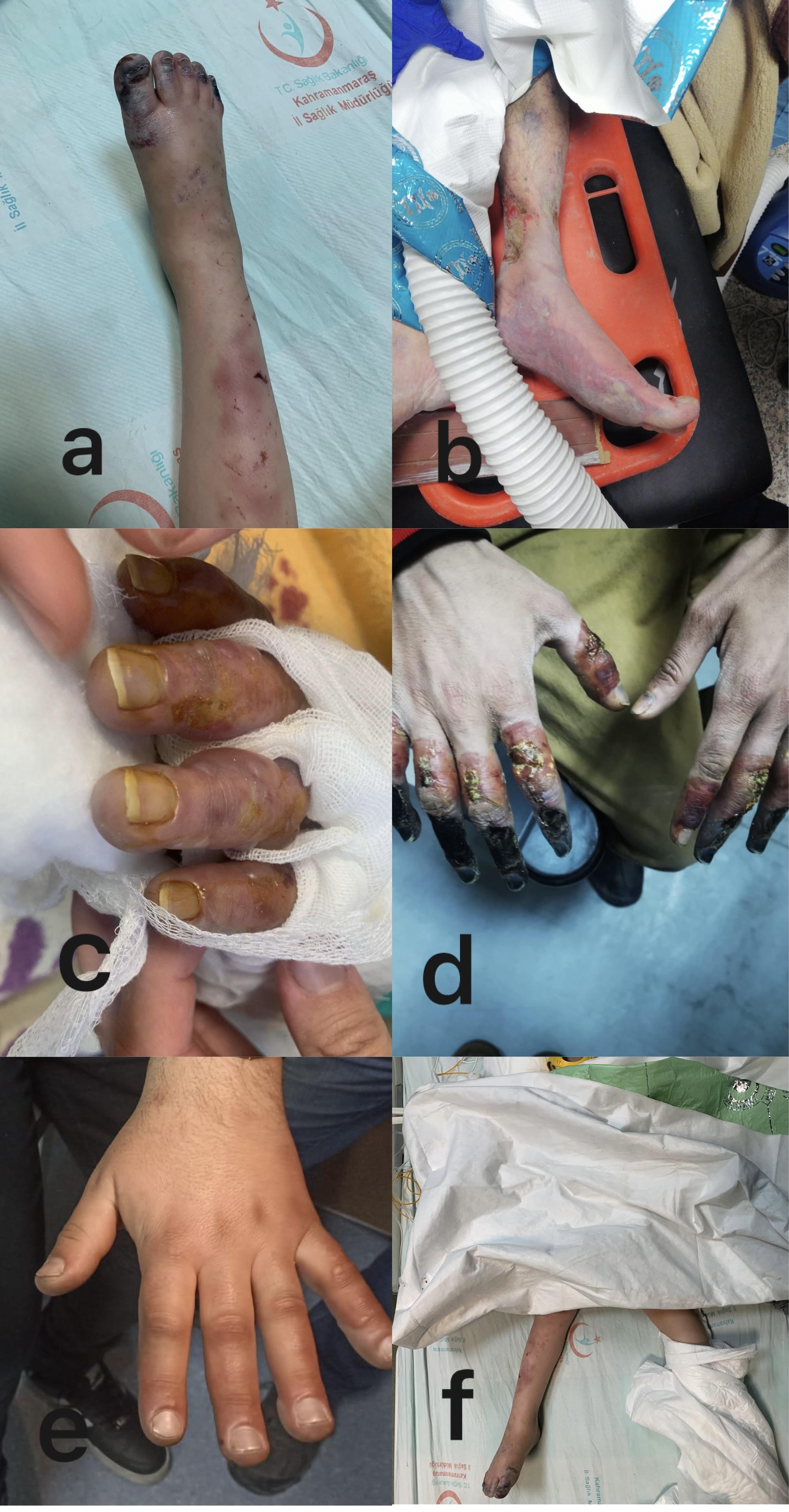 Figures of frostbite cases of different degrees. (a) 3rd and
4th degree burns, necrotic tissue, (b) 3rd degree freezing is characterized by
non-perfused skin, severe edema, (c) 2nd and 3rd degree burns, clear fluid-filled
blisters, (d) 4th degree frostbite, hard & black texture, (e) 1st degree simple
frostbite, (f) 3rd degree burn with multiple trauma.