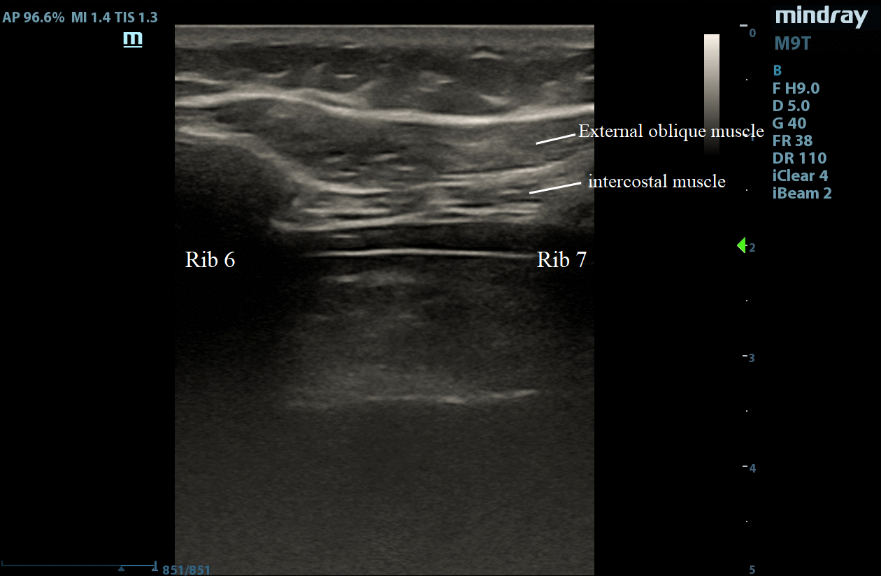Ultrasound-guided visualization of the external oblique
intercostal block.