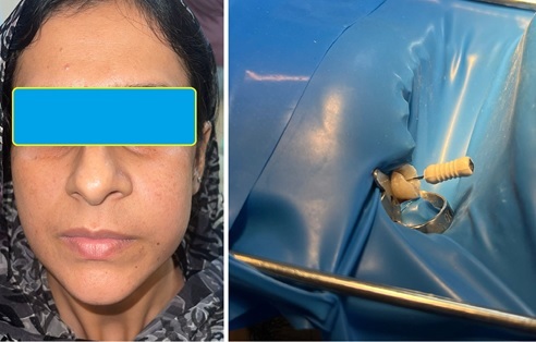 Patient with acute apical
abscess underwent an emergency chamber opening.