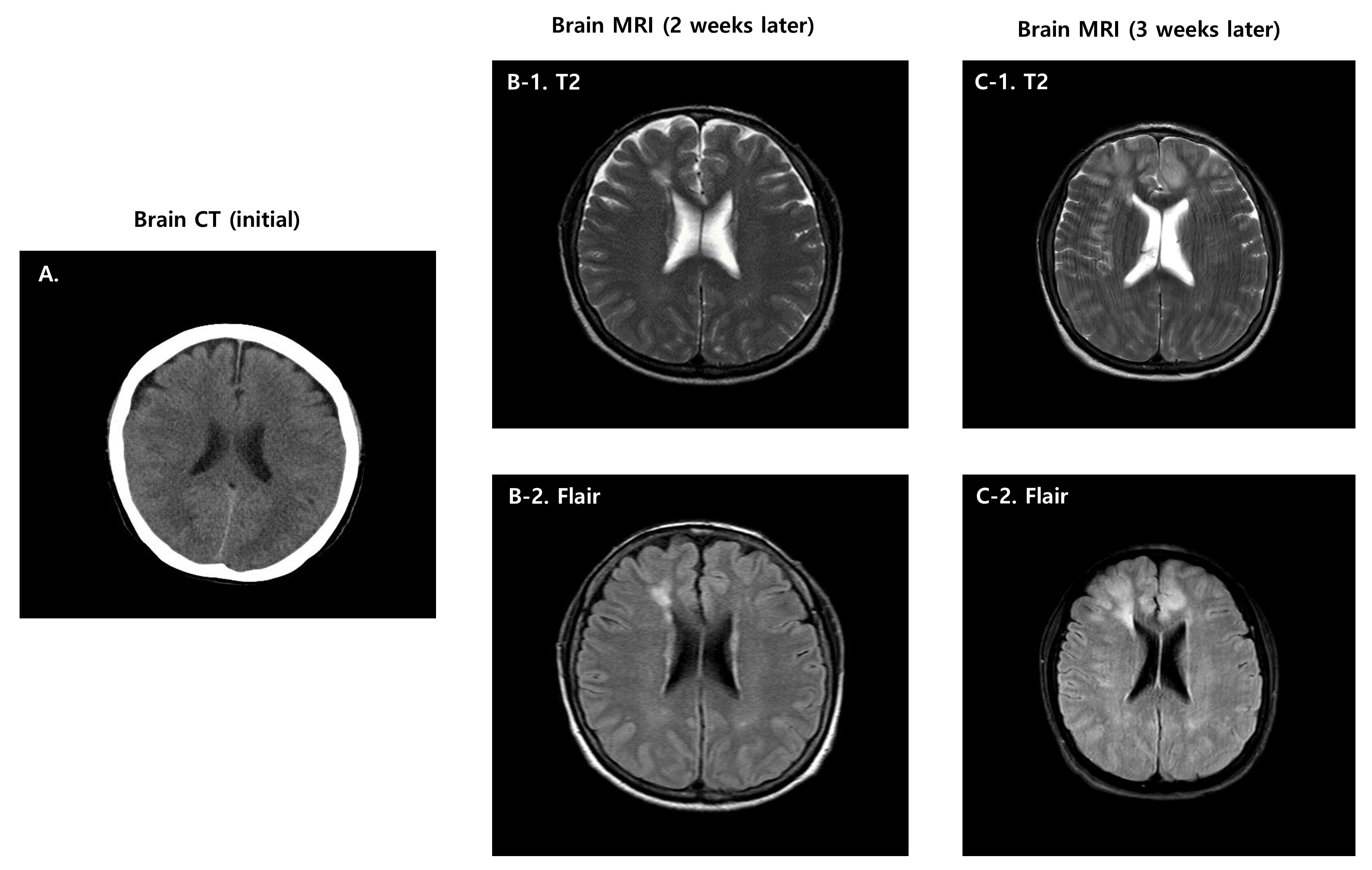 Brain image of the patient. (A) Initial Brain CT is non-specific.
(B-1) T2 MRI findings (2 weeks later) showing bilateral symmetric diffusion
restriction in the bilateral frontal and insular lobes. (B-2) Flair MRI findings
(2 weeks later) showing hyperintensities in the bilateral frontal and insular
lobes. (C-1) T2 MRI findings (3 weeks later) showing worsening bilateral
symmetric diffusion restriction in multiple lobes. (C-2) Flair MRI findings (3
weeks later) showing hyperintensities in multiple lobes. CT: computed tomography;
MRI: magnetic resonance imaging.