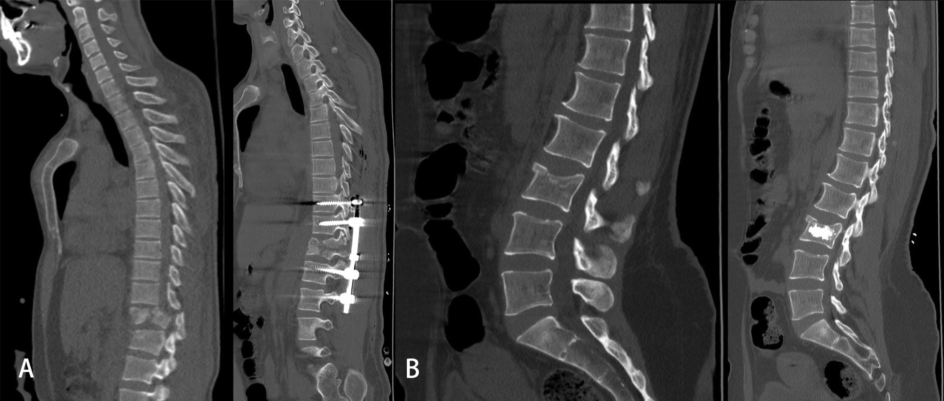 Sagittal computerized tomography images of the patient who
underwent surgery with conventional method as screws and rods. (A) Preoperative
and Postoperative sagittal section CT image showing surgery with screws and rods.
(B) Preoperative and Postoperative sagittal section CT image showing of minimally
invasive cementoplasty.