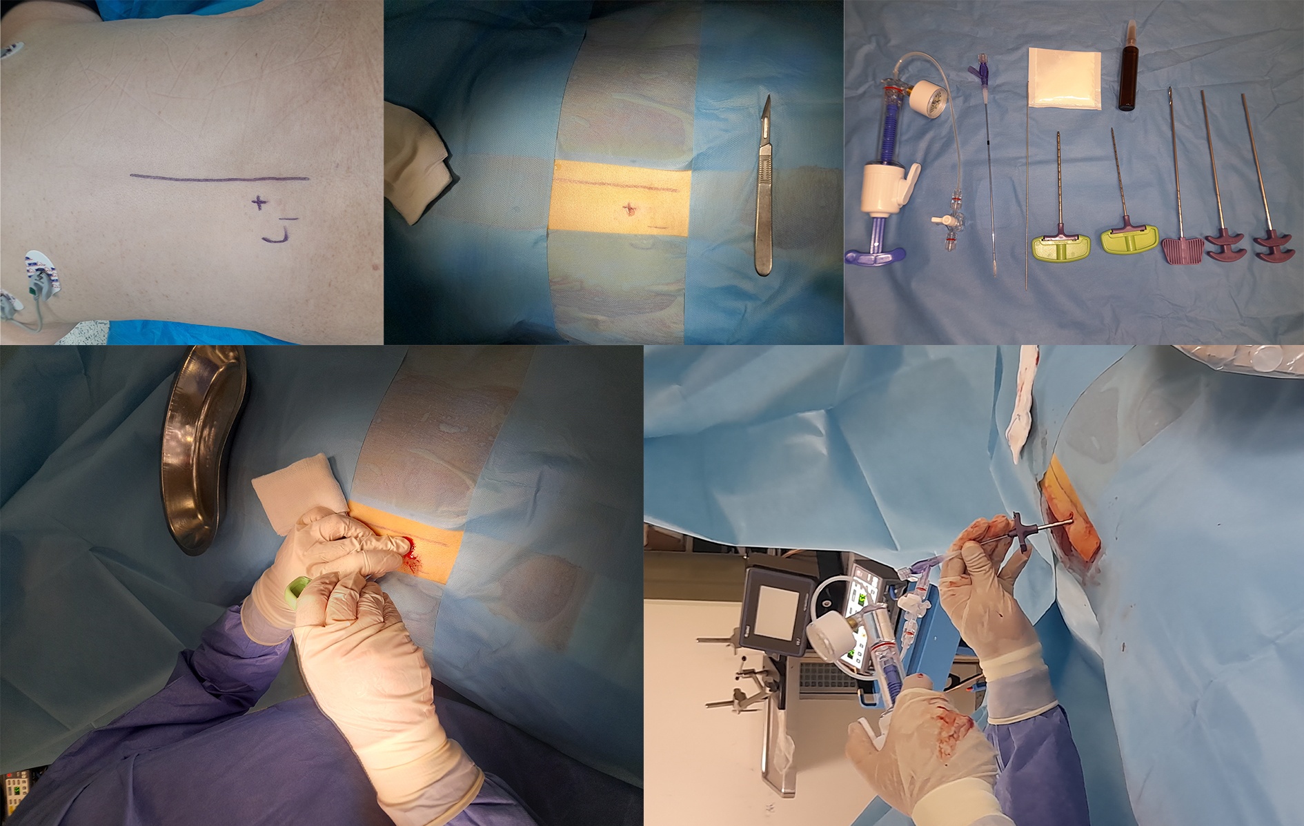 Demonstration of the surgical stages of balloon kyphoplasty and
vertebroplasty.